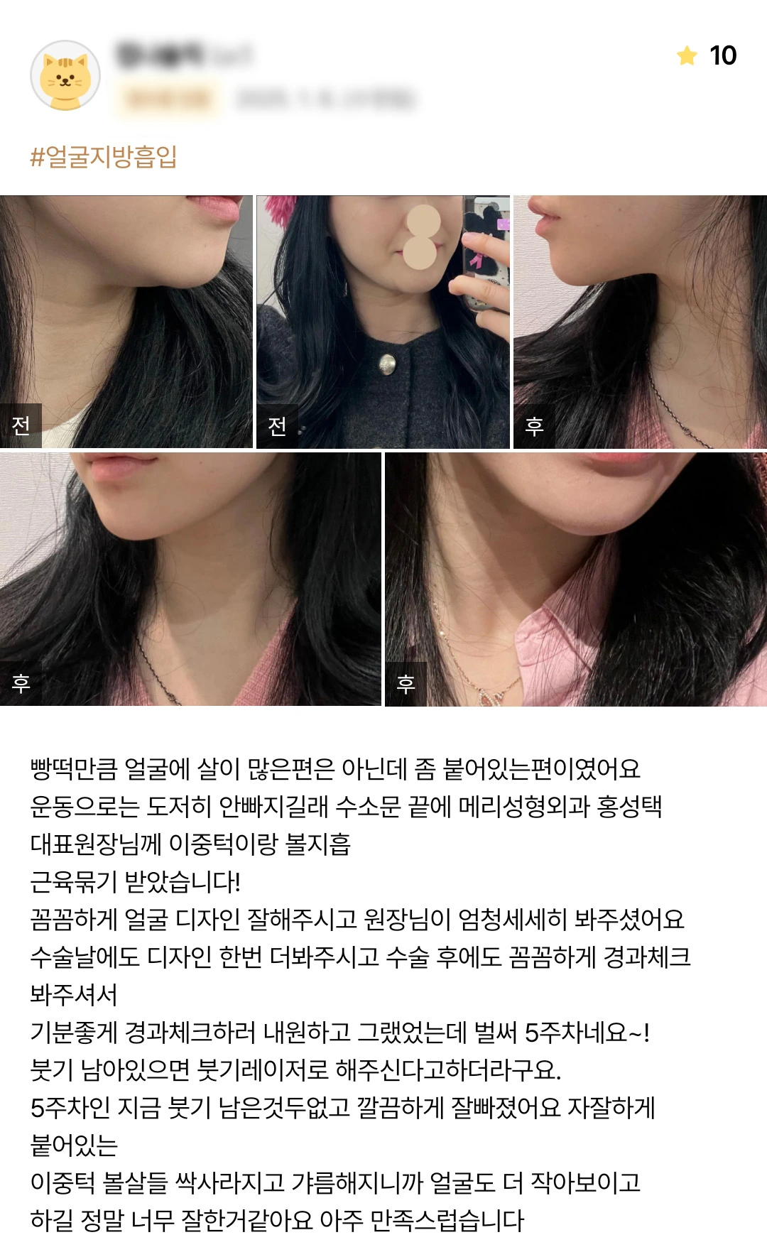 Double-chin and cheek liposuction with muscle tightening patient photo review — 199 at Merry Plastic Surgery Clinic. Double-chin and cheek liposuction with muscle tightening at Merry Plastic Surgery: before-and-after photographs shown in the supplied patient review. The source labels the follow-up as 5 weeks.