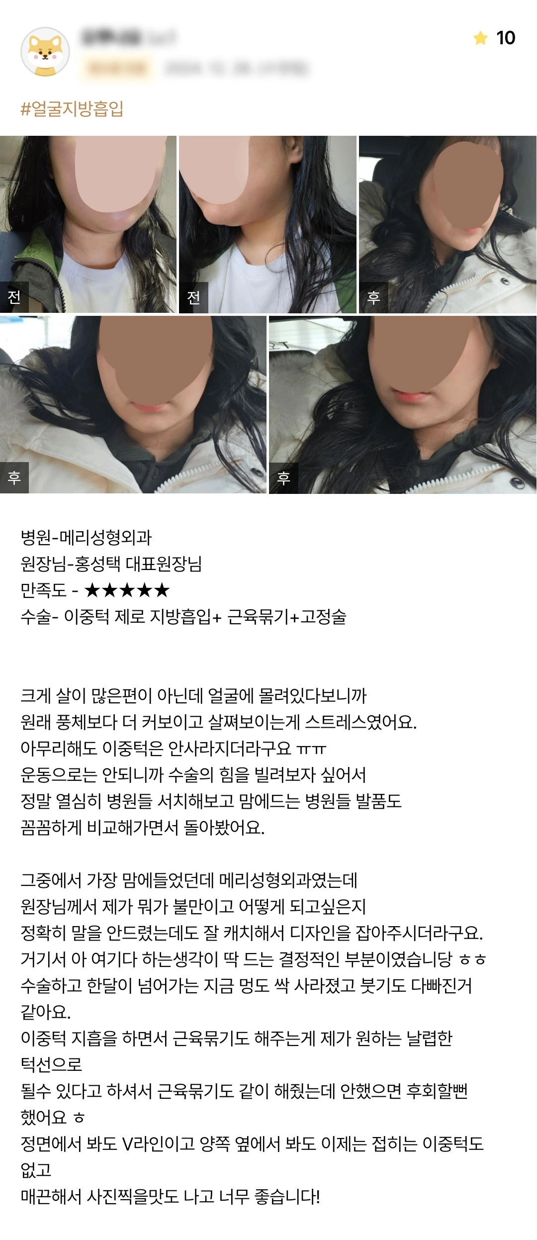 Double-chin liposuction with muscle tightening and fixation patient photo review — 200 at Merry Plastic Surgery Clinic. Double-chin liposuction with muscle tightening and fixation at Merry Plastic Surgery: before-and-after photographs shown in the supplied patient review.