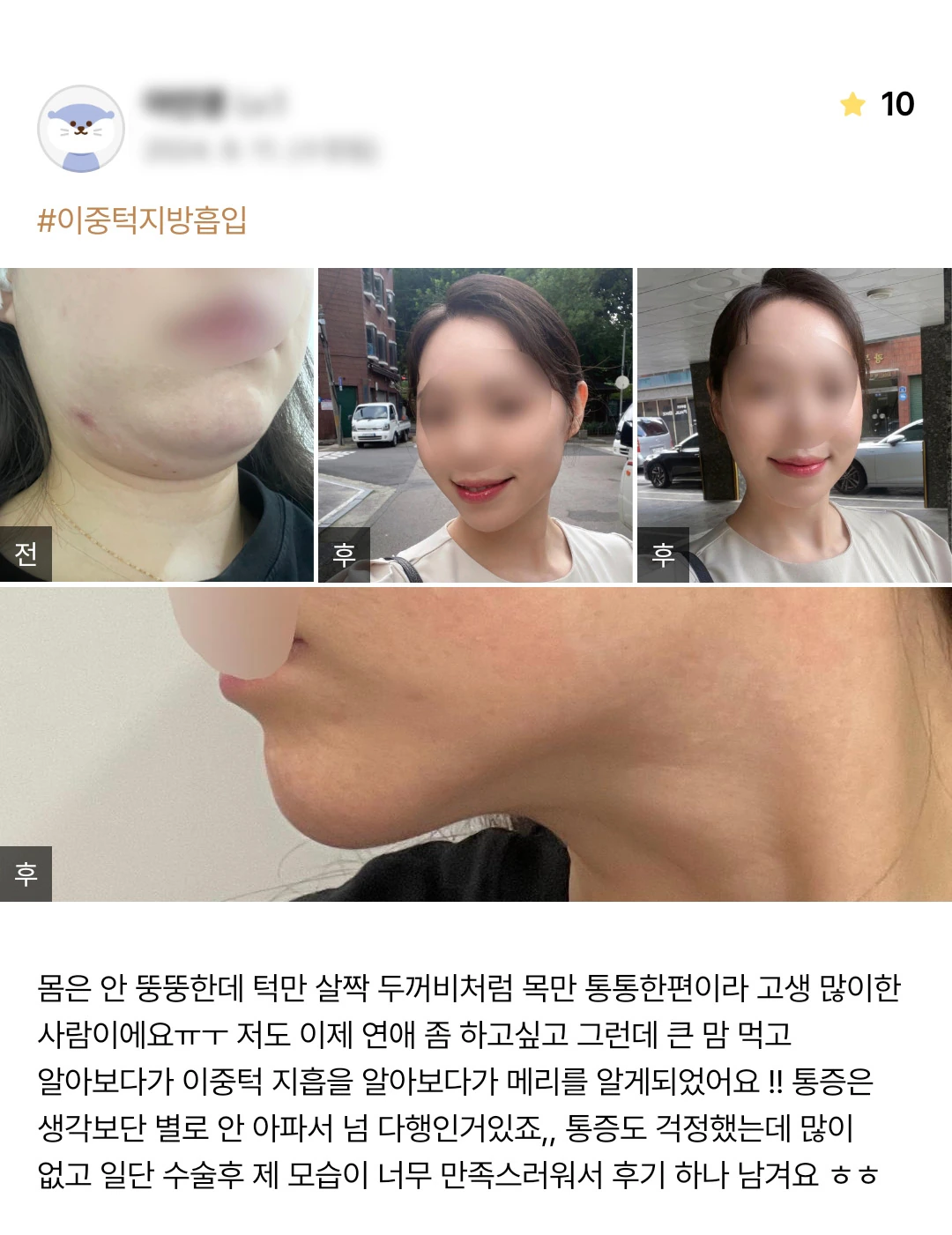 Double-chin liposuction patient photo review — 201 at Merry Plastic Surgery Clinic. Double-chin liposuction at Merry Plastic Surgery: before-and-after photographs shown in the supplied patient review.