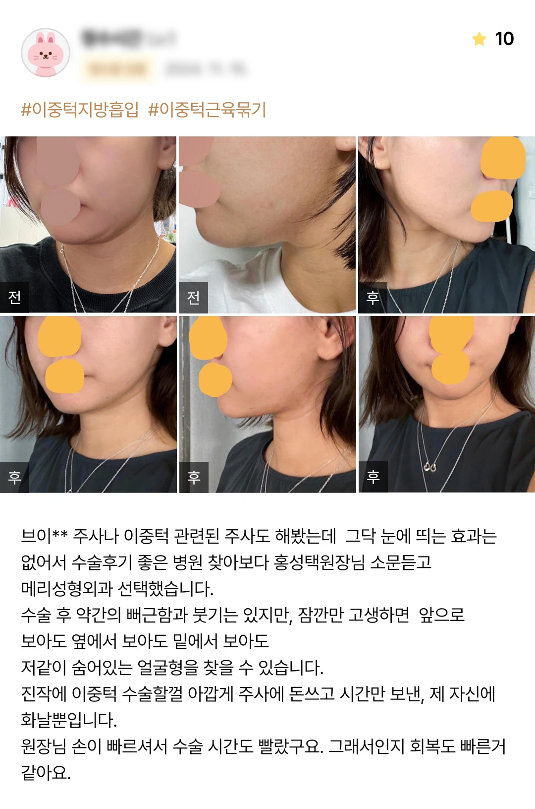 Double-chin liposuction with muscle tightening patient photo review — 203 at Merry Plastic Surgery Clinic. Double-chin liposuction with muscle tightening at Merry Plastic Surgery: before-and-after photographs shown in the supplied patient review.