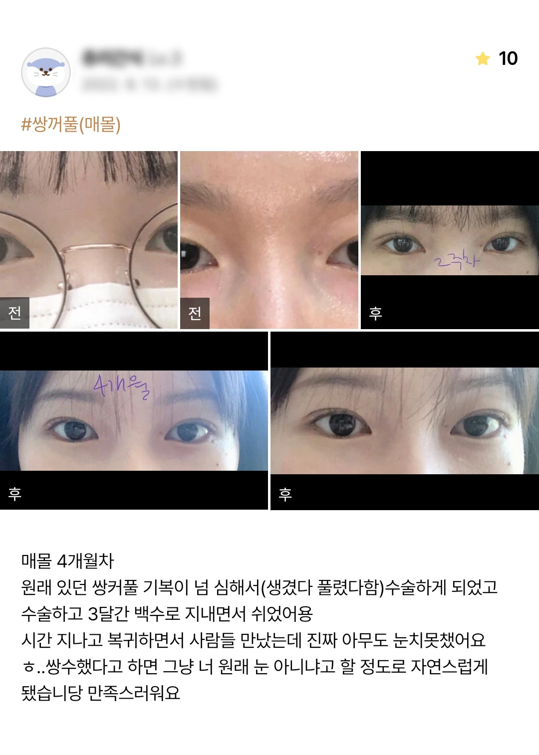 Non-incisional double-eyelid surgery patient photo review — 206 at Merry Plastic Surgery Clinic. Non-incisional double-eyelid surgery at Merry Plastic Surgery: before-and-after photographs shown in the supplied patient review. The source labels the follow-up as 4 months.