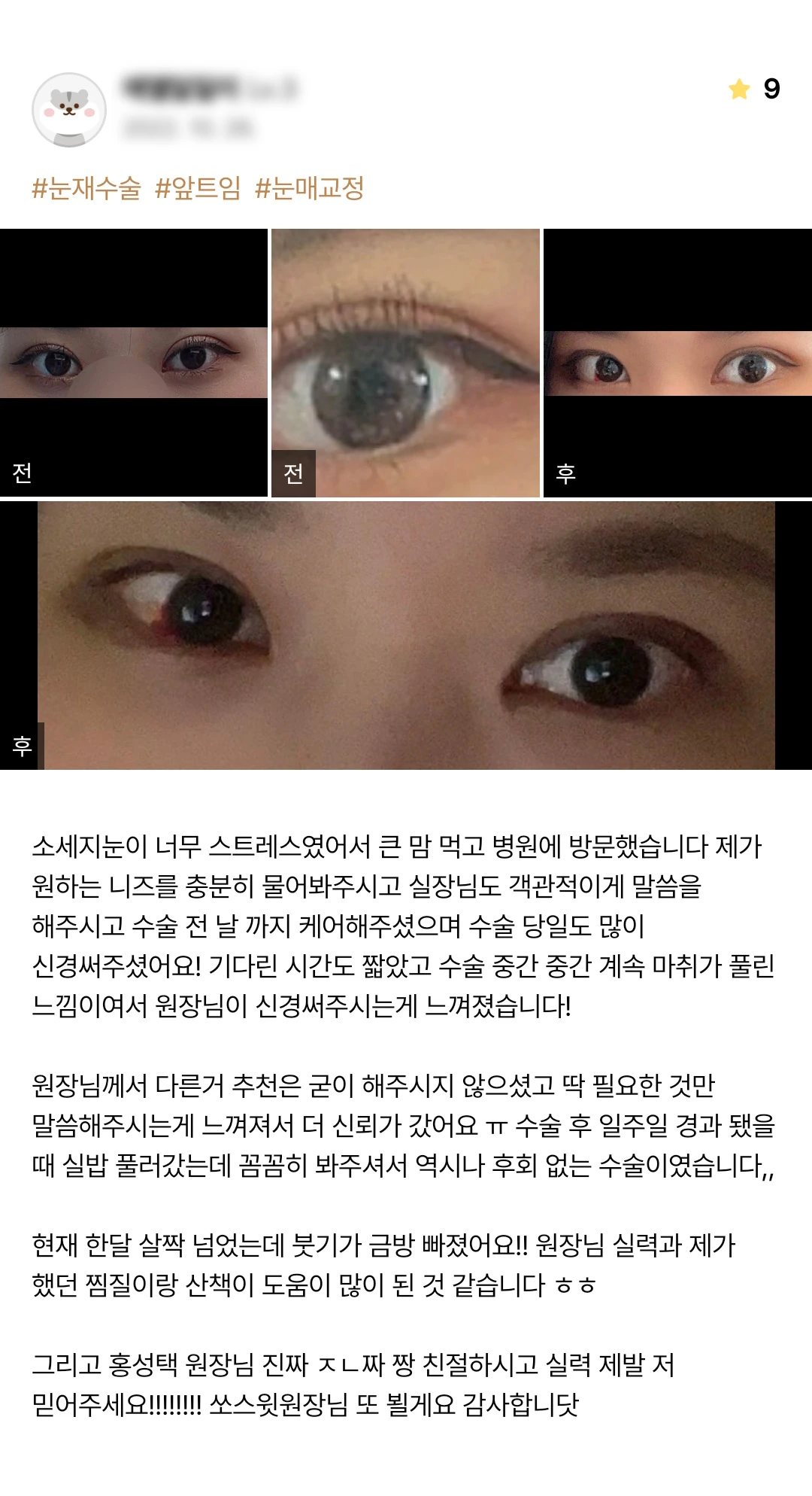 Revision eyelid surgery with canthoplasty and ptosis correction patient photo review — 207 at Merry Plastic Surgery Clinic. Revision eyelid surgery with canthoplasty and ptosis correction at Merry Plastic Surgery: before-and-after photographs shown in the supplied patient review.