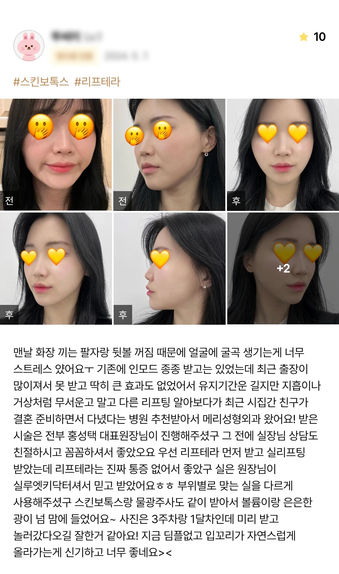Liftera ultrasound lifting, thread lifting and skin botulinum toxin patient photo review — 208 at Merry Plastic Surgery Clinic. Liftera ultrasound lifting, thread lifting and skin botulinum toxin at Merry Plastic Surgery: before-and-after photographs shown in the supplied patient review.