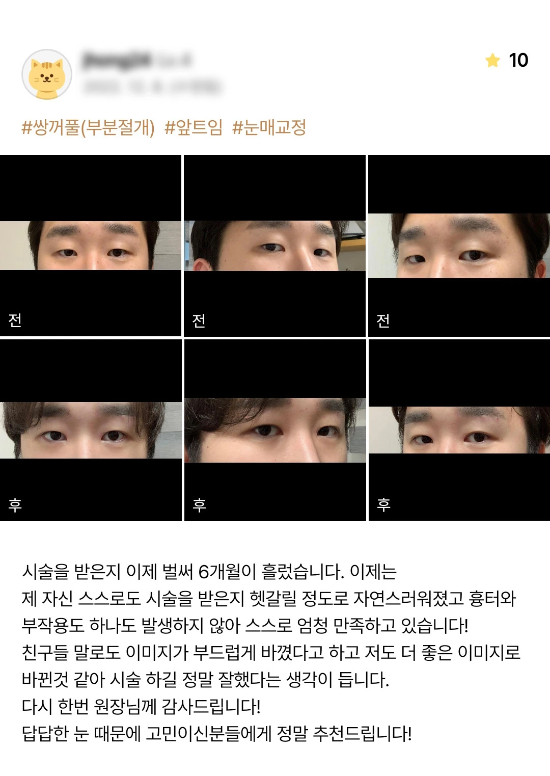 Partial-incision eyelid surgery, epicanthoplasty and ptosis correction patient photo review — 209 at Merry Plastic Surgery Clinic. Partial-incision eyelid surgery, epicanthoplasty and ptosis correction at Merry Plastic Surgery: before-and-after photographs shown in the supplied patient review. The source labels the…