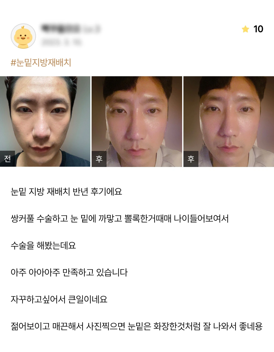 Under-eye fat repositioning patient photo review — 211 at Merry Plastic Surgery Clinic. Under-eye fat repositioning at Merry Plastic Surgery: before-and-after photographs shown in the supplied patient review. The source labels the follow-up as 6 months.