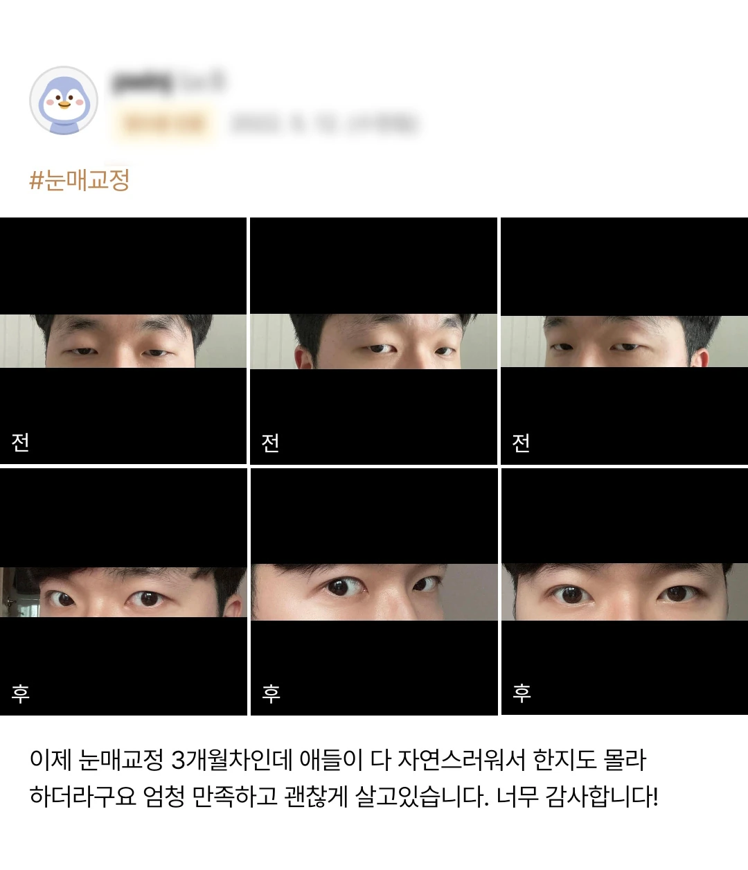 Ptosis correction patient photo review — 214 at Merry Plastic Surgery Clinic. Ptosis correction at Merry Plastic Surgery: before-and-after photographs shown in the supplied patient review. The source labels the follow-up as 3 months.