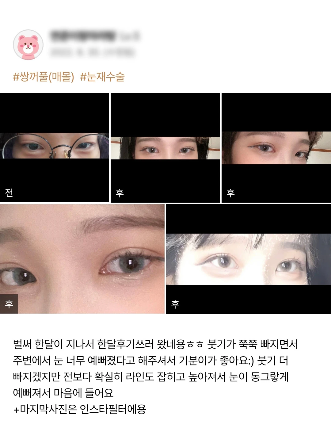 Revision non-incisional double-eyelid surgery patient photo review — 215 at Merry Plastic Surgery Clinic. Revision non-incisional double-eyelid surgery at Merry Plastic Surgery: before-and-after photographs shown in the supplied patient review. The source labels the follow-up as 1 month.