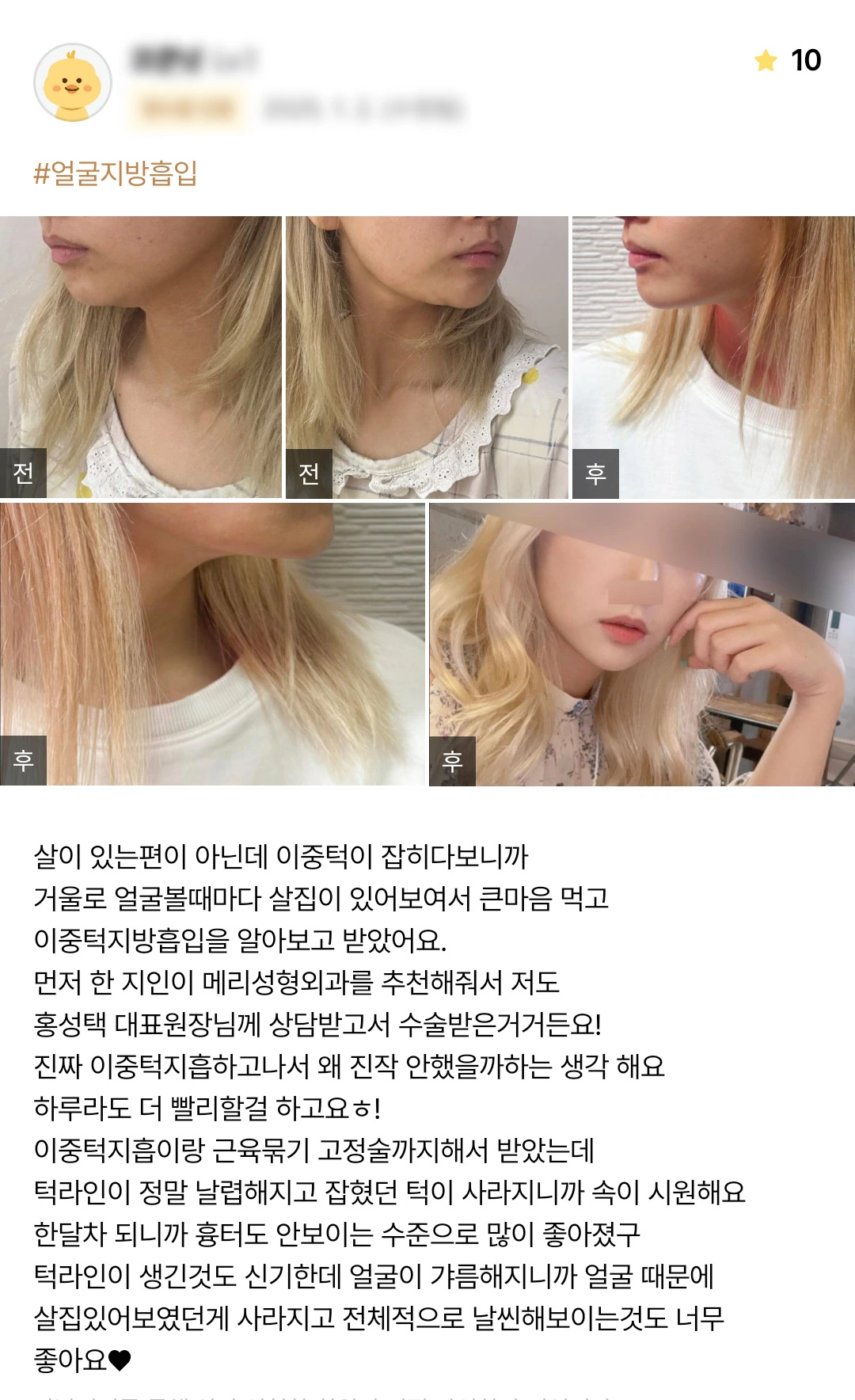 Double-chin liposuction with muscle tightening and fixation patient photo review — 216 at Merry Plastic Surgery Clinic. Double-chin liposuction with muscle tightening and fixation at Merry Plastic Surgery: before-and-after photographs shown in the supplied patient review.