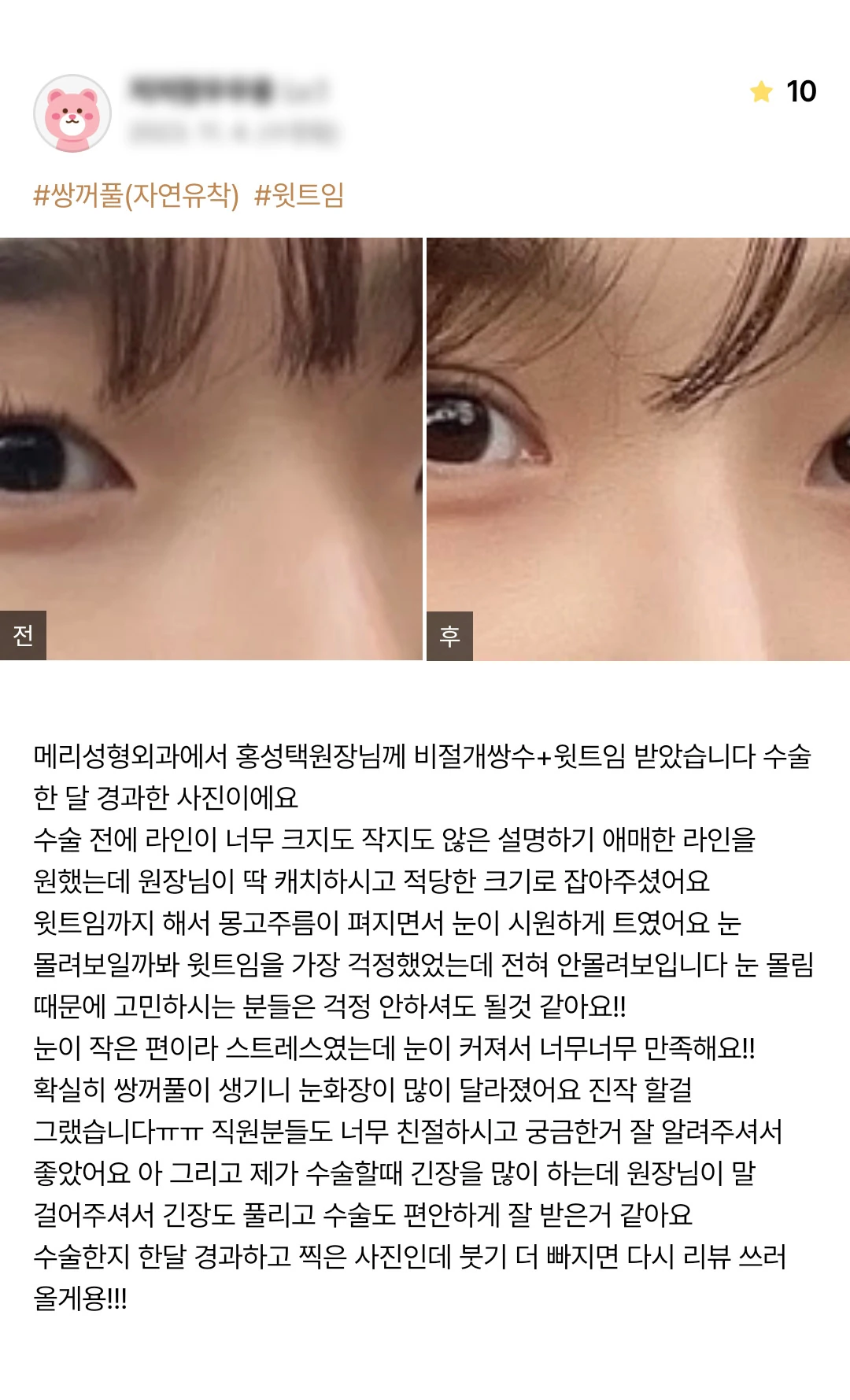 Non-incisional double-eyelid surgery and upper epicanthoplasty patient photo review — 217 at Merry Plastic Surgery Clinic. Non-incisional double-eyelid surgery and upper epicanthoplasty at Merry Plastic Surgery: before-and-after photographs shown in the supplied patient review. The source labels the follow-up as 1…