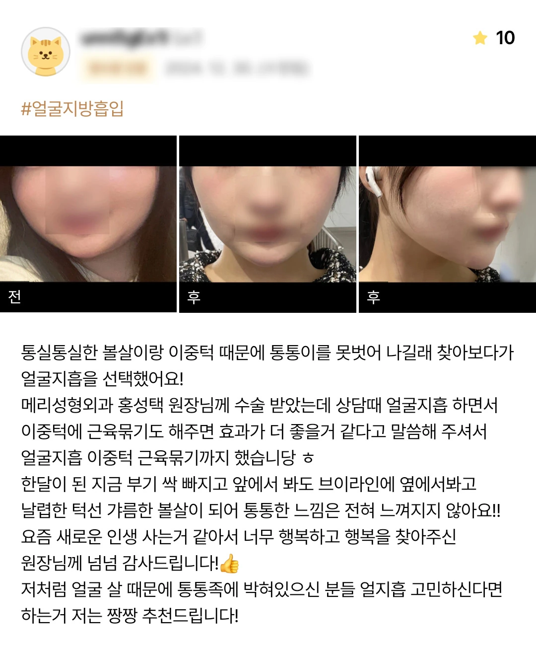 Facial liposuction with muscle tightening patient photo review — 220 at Merry Plastic Surgery Clinic. Facial liposuction with muscle tightening at Merry Plastic Surgery: before-and-after photographs shown in the supplied patient review. The source labels the follow-up as 1 month.