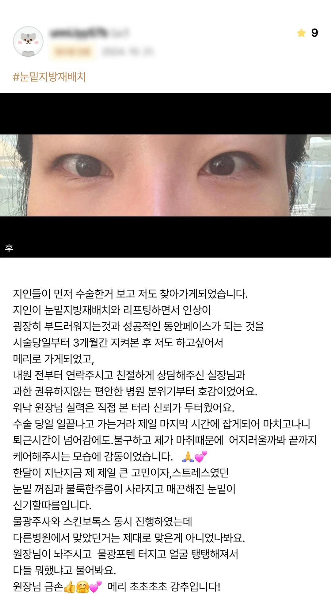 Under-eye fat repositioning patient photo review — 221 at Merry Plastic Surgery Clinic. Under-eye fat repositioning at Merry Plastic Surgery: patient-shared postoperative photograph in the supplied review.