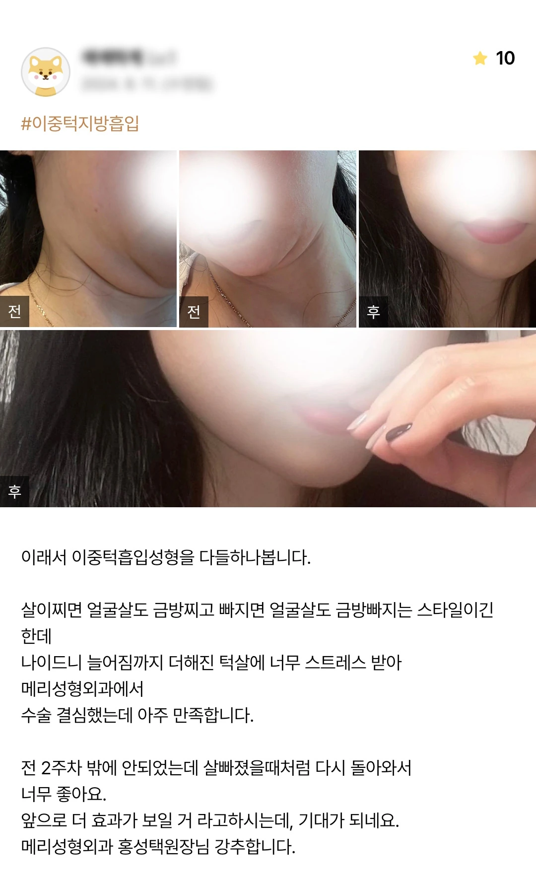 Double-chin liposuction patient photo review — 222 at Merry Plastic Surgery Clinic. Double-chin liposuction at Merry Plastic Surgery: before-and-after photographs shown in the supplied patient review.
