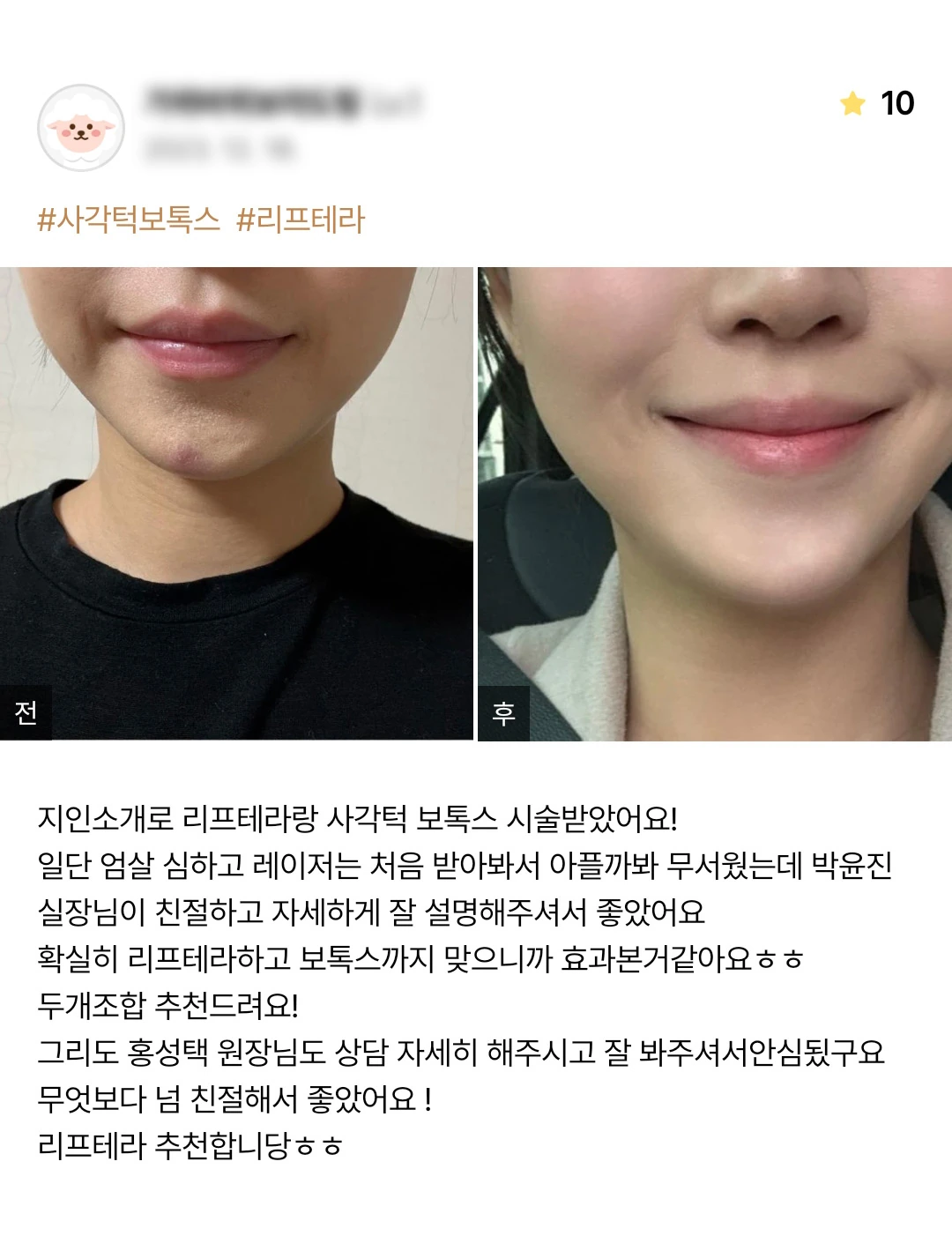 Liftera ultrasound lifting and masseter botulinum toxin patient photo review — 223 at Merry Plastic Surgery Clinic. Liftera ultrasound lifting and masseter botulinum toxin at Merry Plastic Surgery: before-and-after photographs shown in the supplied patient review.