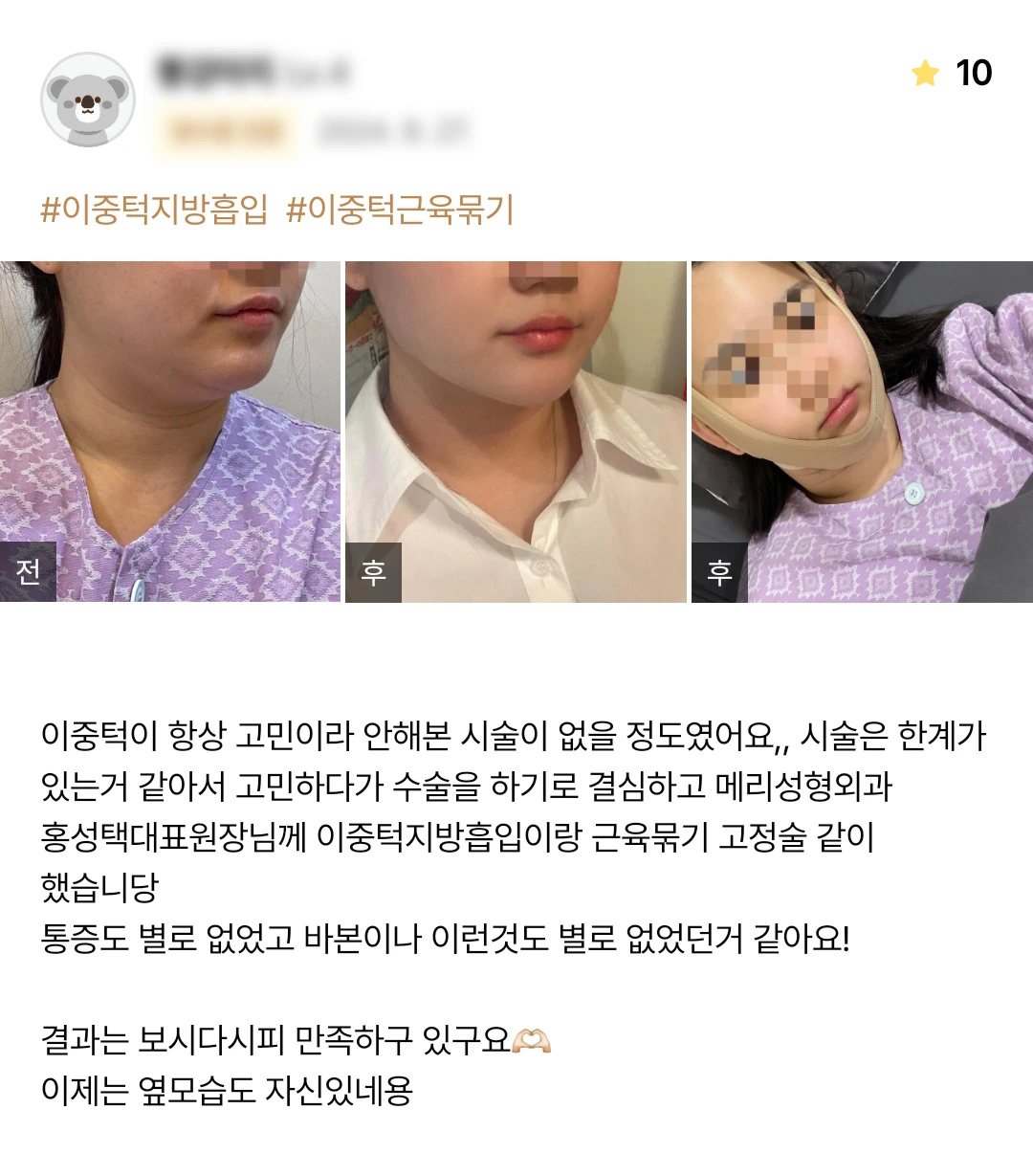 Double-chin liposuction with muscle tightening and fixation patient photo review — 224 at Merry Plastic Surgery Clinic. Double-chin liposuction with muscle tightening and fixation at Merry Plastic Surgery: before-and-after photographs shown in the supplied patient review.
