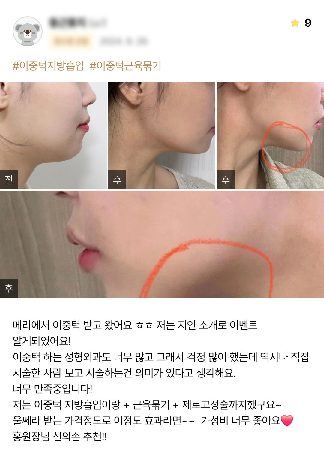 Double-chin liposuction with muscle tightening and fixation patient photo review — 226 at Merry Plastic Surgery Clinic. Double-chin liposuction with muscle tightening and fixation at Merry Plastic Surgery: before-and-after photographs shown in the supplied patient review.