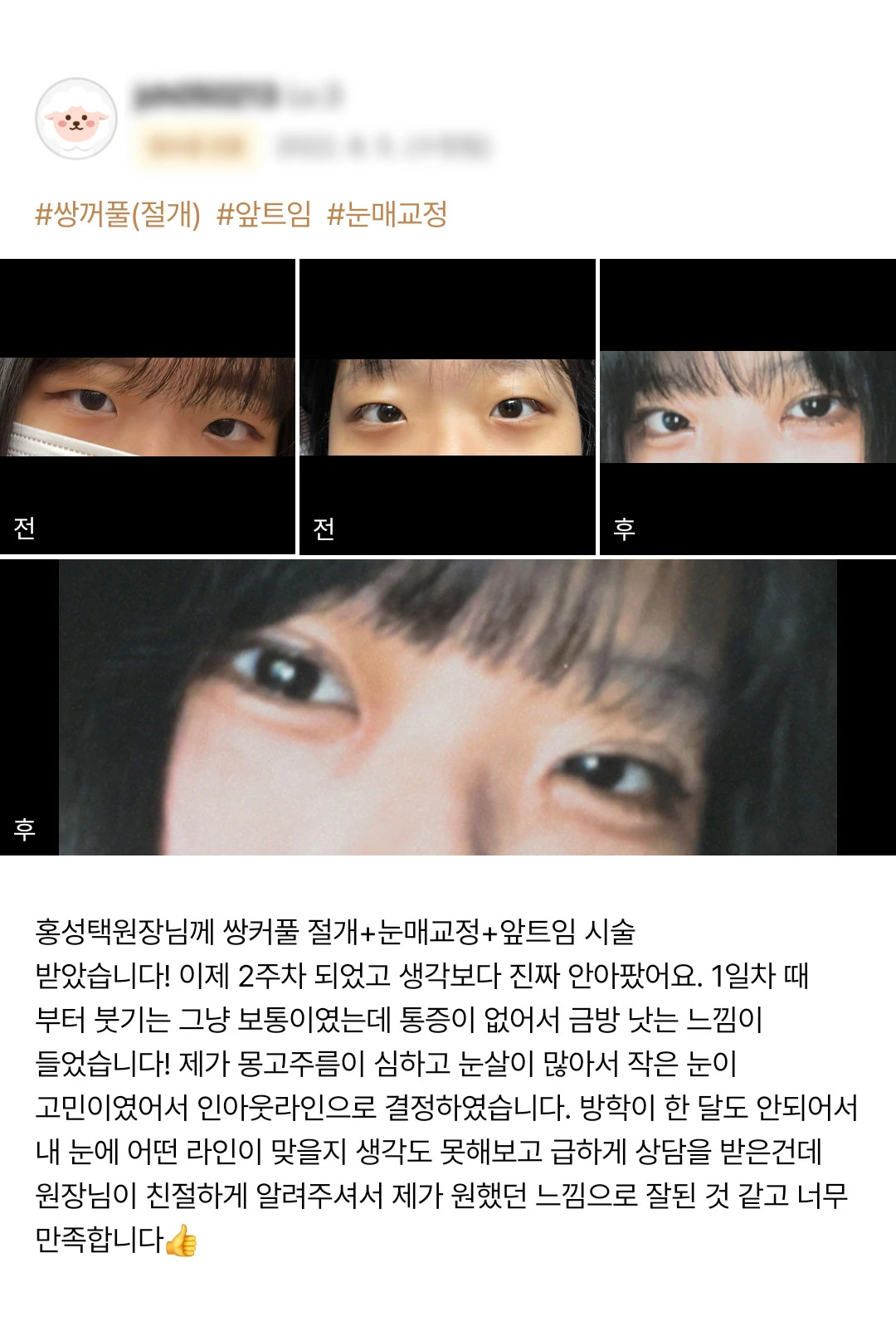 Incisional double-eyelid surgery, epicanthoplasty and ptosis correction patient photo review — 227 at Merry Plastic Surgery Clinic. Incisional double-eyelid surgery, epicanthoplasty and ptosis correction at Merry Plastic Surgery: before-and-after photographs shown in the supplied patient review. The source labels the…