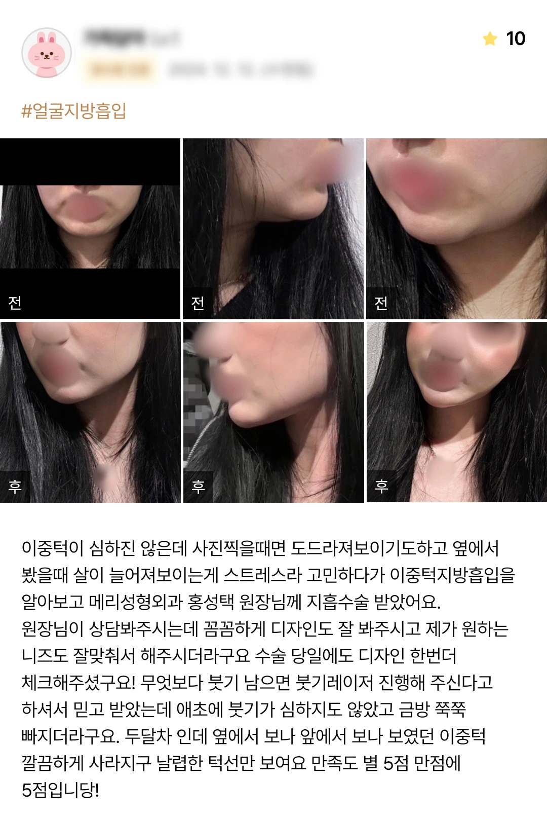Double-chin liposuction patient photo review — 230 at Merry Plastic Surgery Clinic. Double-chin liposuction at Merry Plastic Surgery: before-and-after photographs shown in the supplied patient review.