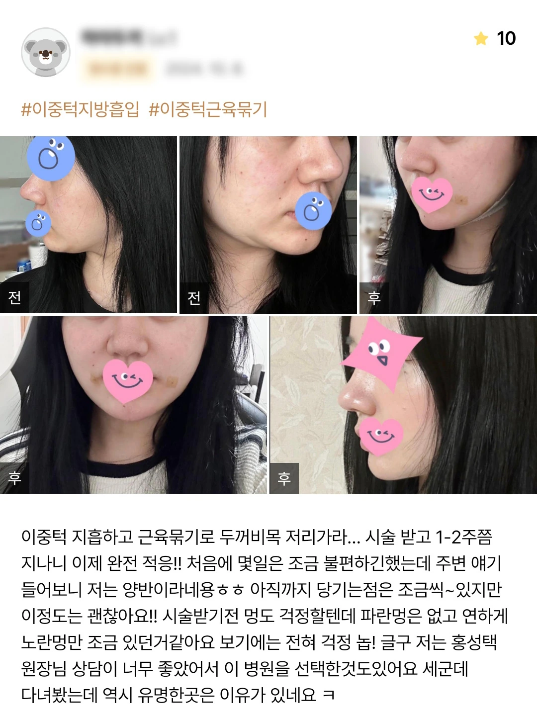 Double-chin liposuction and muscle tightening patient photo review — 231 at Merry Plastic Surgery Clinic. Double-chin liposuction and muscle tightening at Merry Plastic Surgery: before-and-after photographs shown in the supplied patient review. The source labels the follow-up as 1–2 weeks.