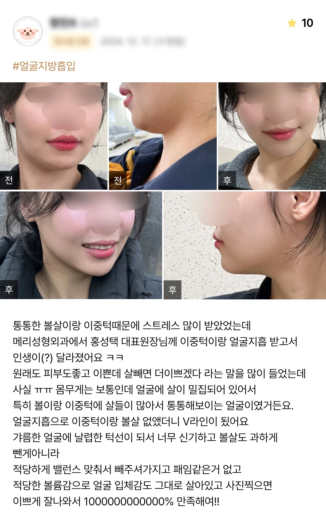 Double-chin liposuction patient photo review — 232 at Merry Plastic Surgery Clinic. Double-chin liposuction at Merry Plastic Surgery: before-and-after photographs shown in the supplied patient review.