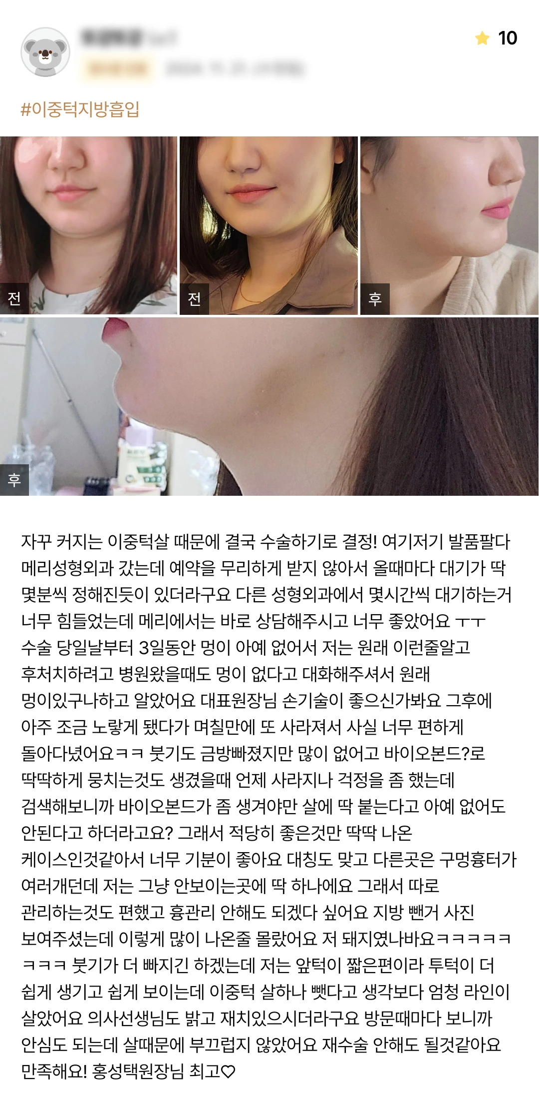 Double-chin liposuction patient photo review — 233 at Merry Plastic Surgery Clinic. Double-chin liposuction at Merry Plastic Surgery: before-and-after photographs shown in the supplied patient review.