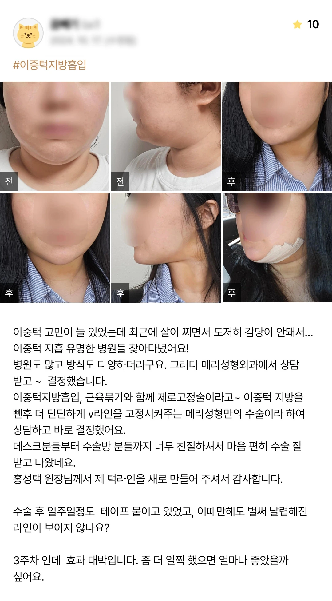 Double-chin liposuction with muscle tightening and fixation patient photo review — 234 at Merry Plastic Surgery Clinic. Double-chin liposuction with muscle tightening and fixation at Merry Plastic Surgery: before-and-after photographs shown in the supplied patient review. The source labels the follow-up as 3 weeks.