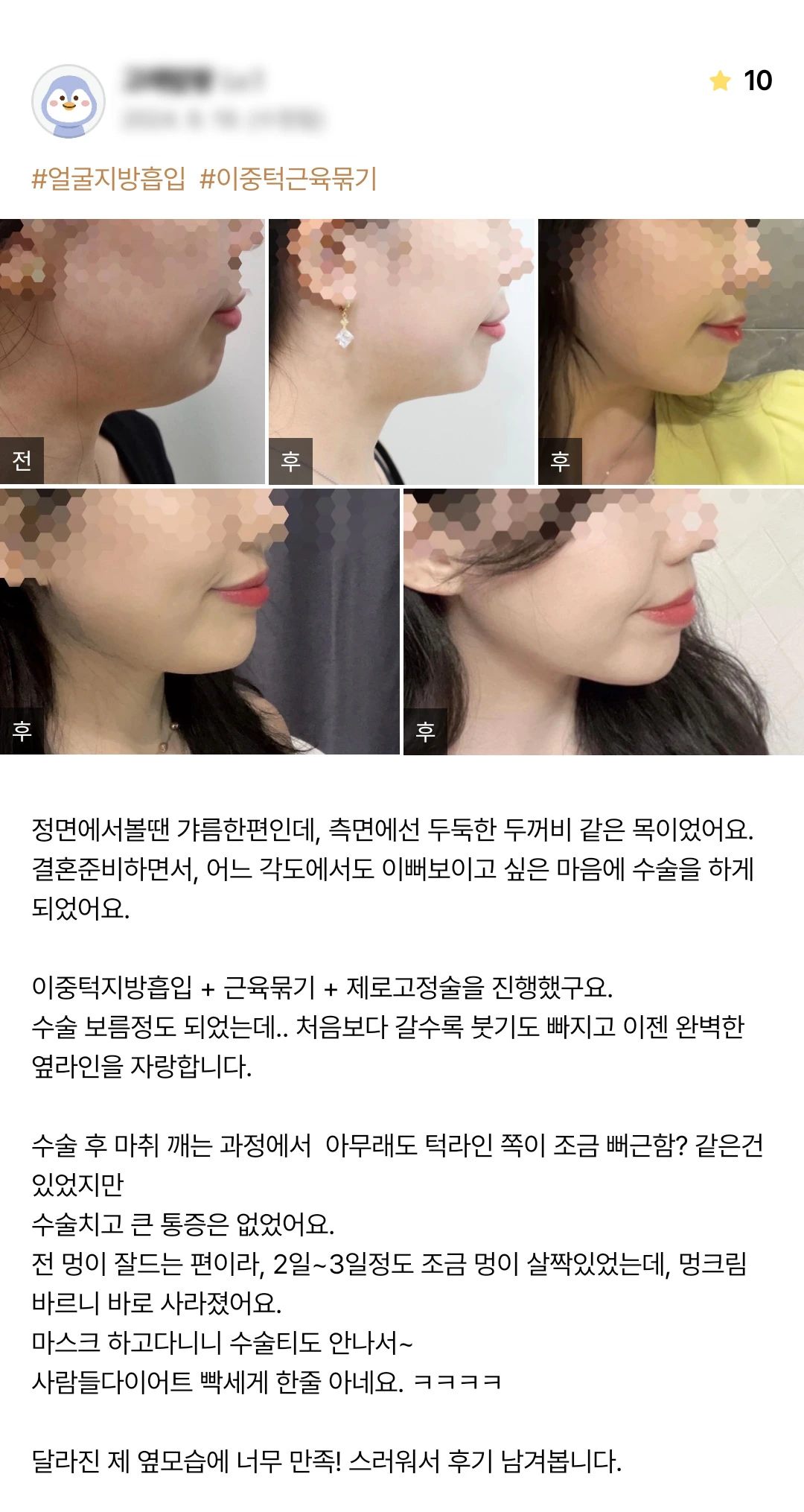 Double-chin liposuction with muscle tightening and fixation patient photo review — 235 at Merry Plastic Surgery Clinic. Double-chin liposuction with muscle tightening and fixation at Merry Plastic Surgery: before-and-after photographs shown in the supplied patient review. The source labels the follow-up as…
