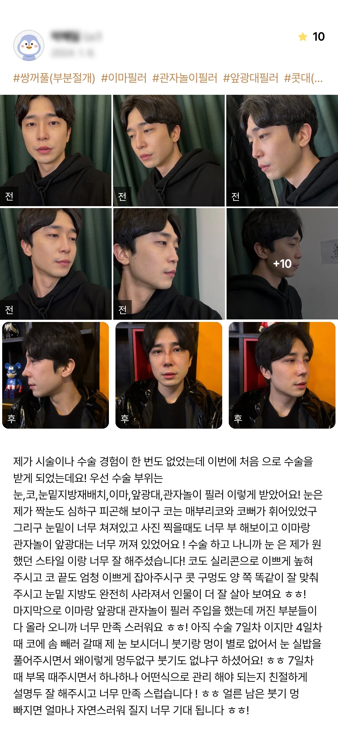 Eyelid surgery, rhinoplasty and facial fat grafting patient photo review — 236 at Merry Plastic Surgery Clinic. Eyelid surgery, rhinoplasty and facial fat grafting at Merry Plastic Surgery: before-and-after photographs shown in the supplied patient review.