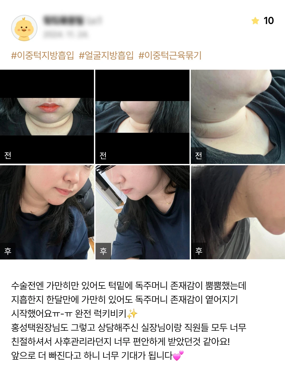 Double-chin and facial liposuction with muscle tightening patient photo review — 237 at Merry Plastic Surgery Clinic. Double-chin and facial liposuction with muscle tightening at Merry Plastic Surgery: before-and-after photographs shown in the supplied patient review.