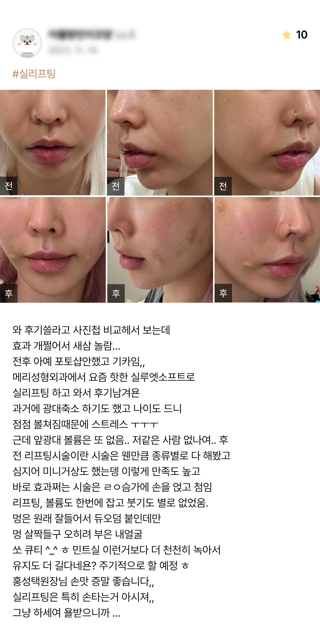 Thread lifting patient photo review — 080 at Merry Plastic Surgery Clinic. Thread lifting at Merry Plastic Surgery: before-and-after photographs shown in the supplied patient review.