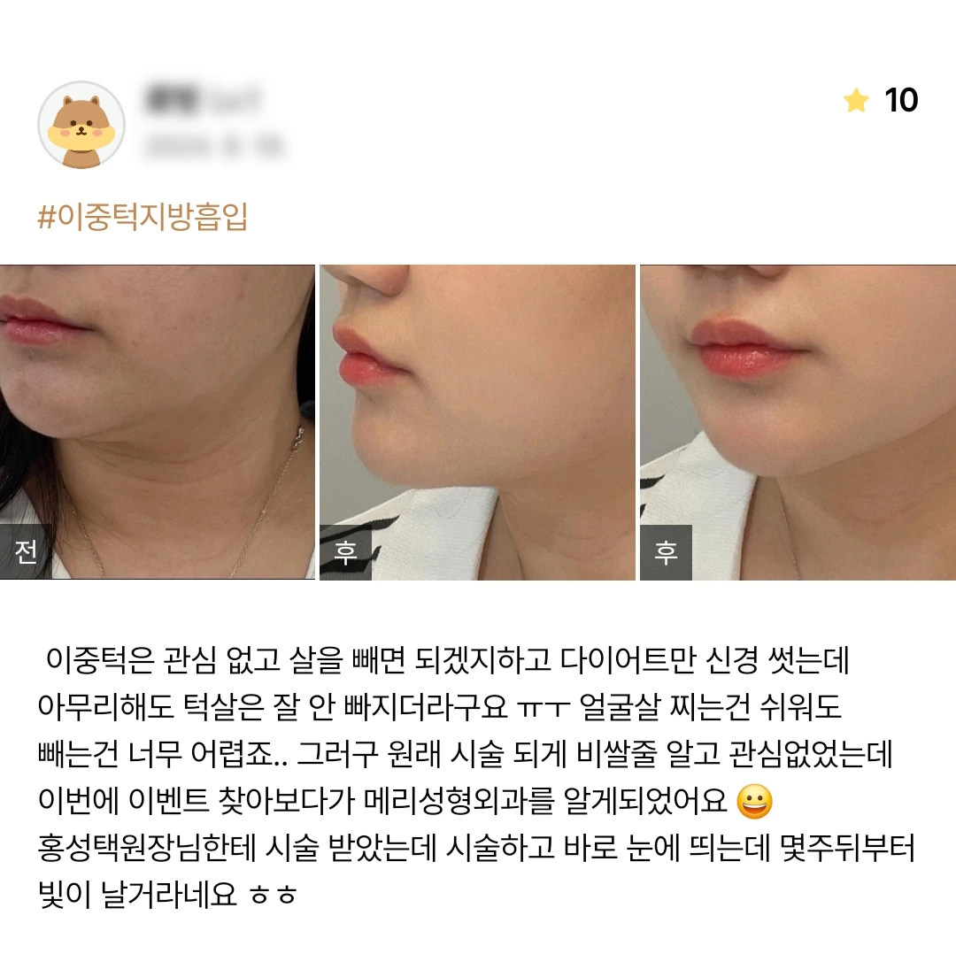 Double-chin liposuction patient photo review — 240 at Merry Plastic Surgery Clinic. Double-chin liposuction at Merry Plastic Surgery: before-and-after photographs shown in the supplied patient review.