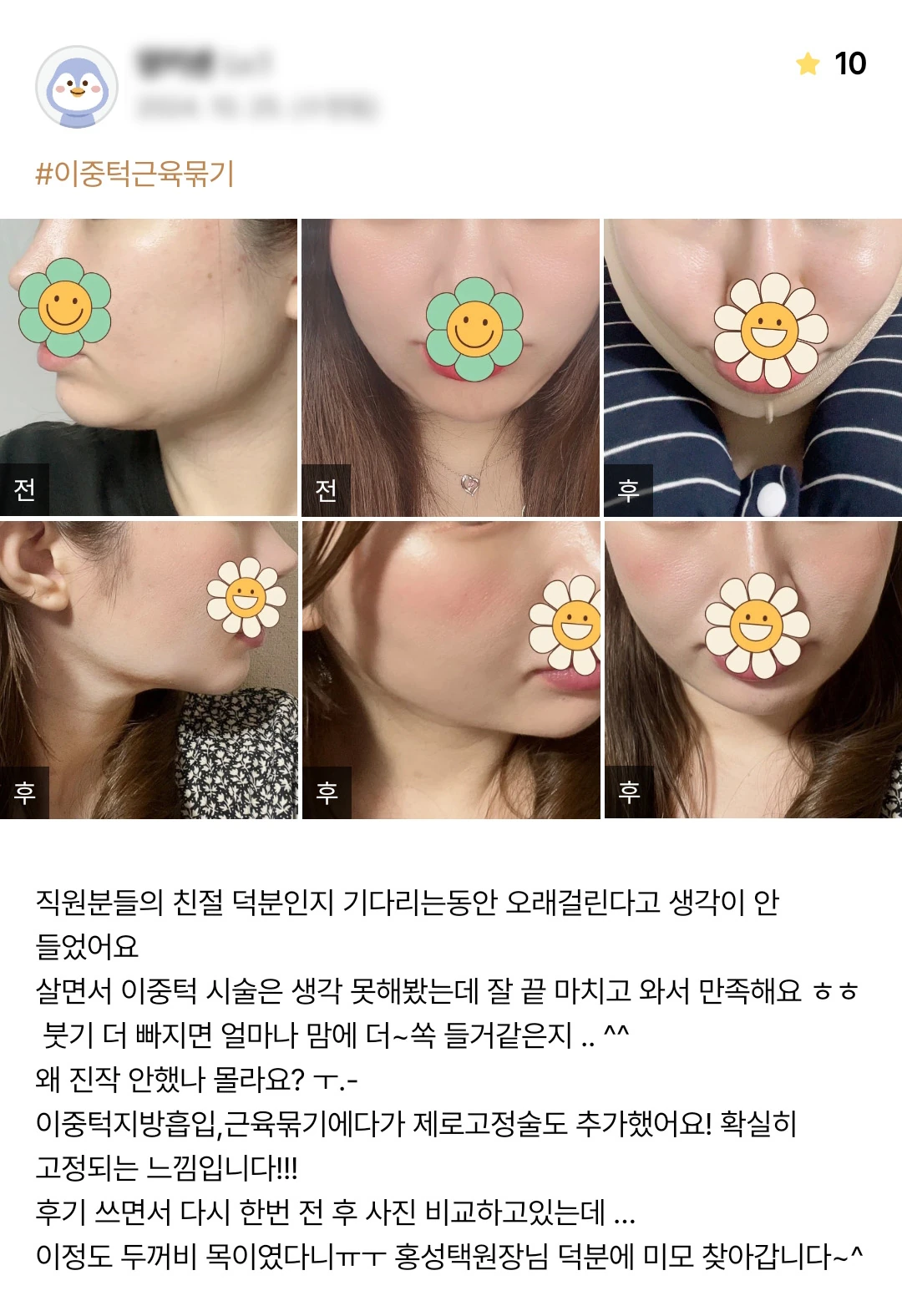 Double-chin muscle tightening with fixation patient photo review — 246 at Merry Plastic Surgery Clinic. Double-chin muscle tightening with fixation at Merry Plastic Surgery: before-and-after photographs shown in the supplied patient review.