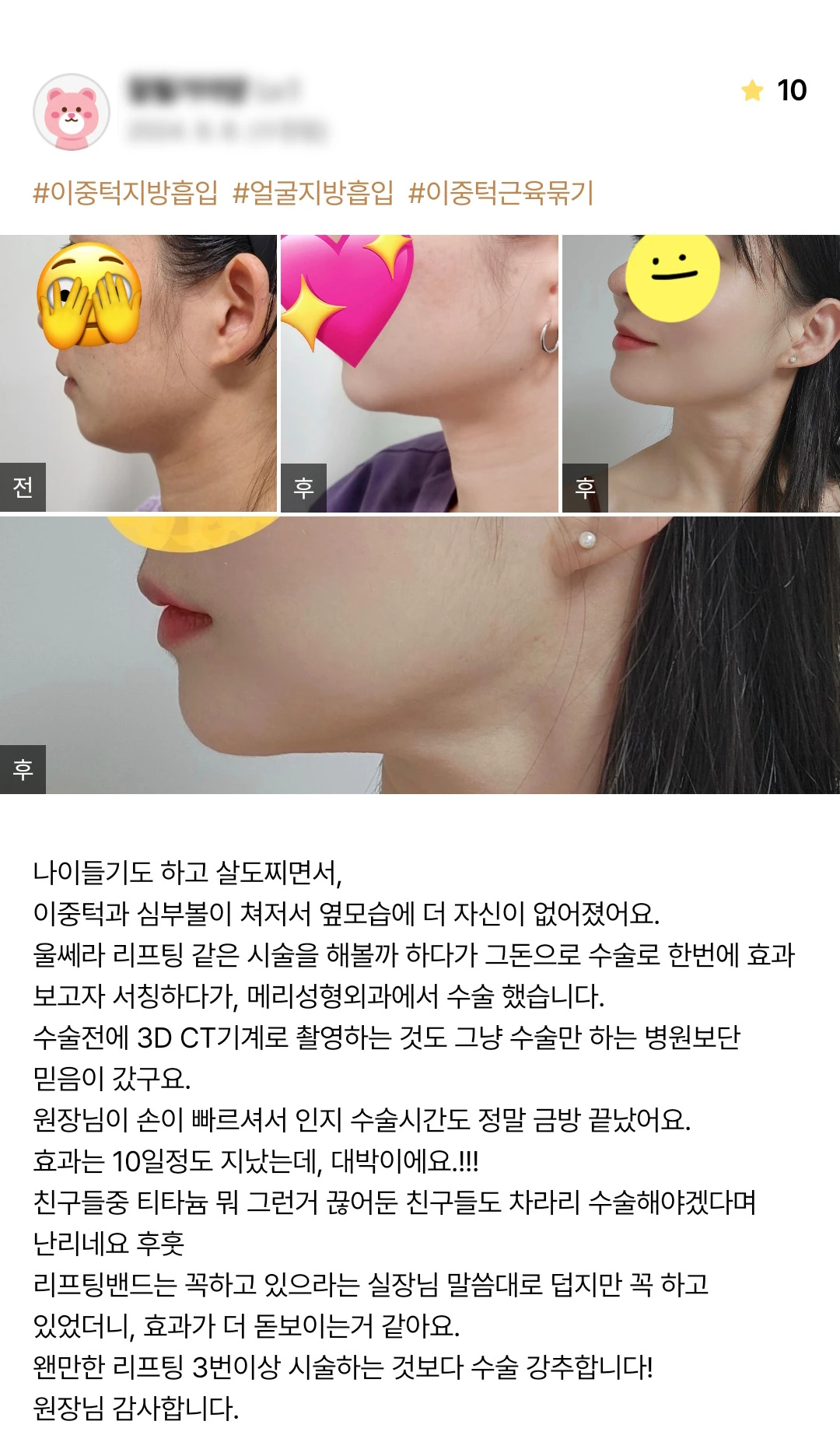 Double-chin and facial liposuction with muscle tightening patient photo review — 247 at Merry Plastic Surgery Clinic. Double-chin and facial liposuction with muscle tightening at Merry Plastic Surgery: before-and-after photographs shown in the supplied patient review. The source labels the follow-up as 10 days.