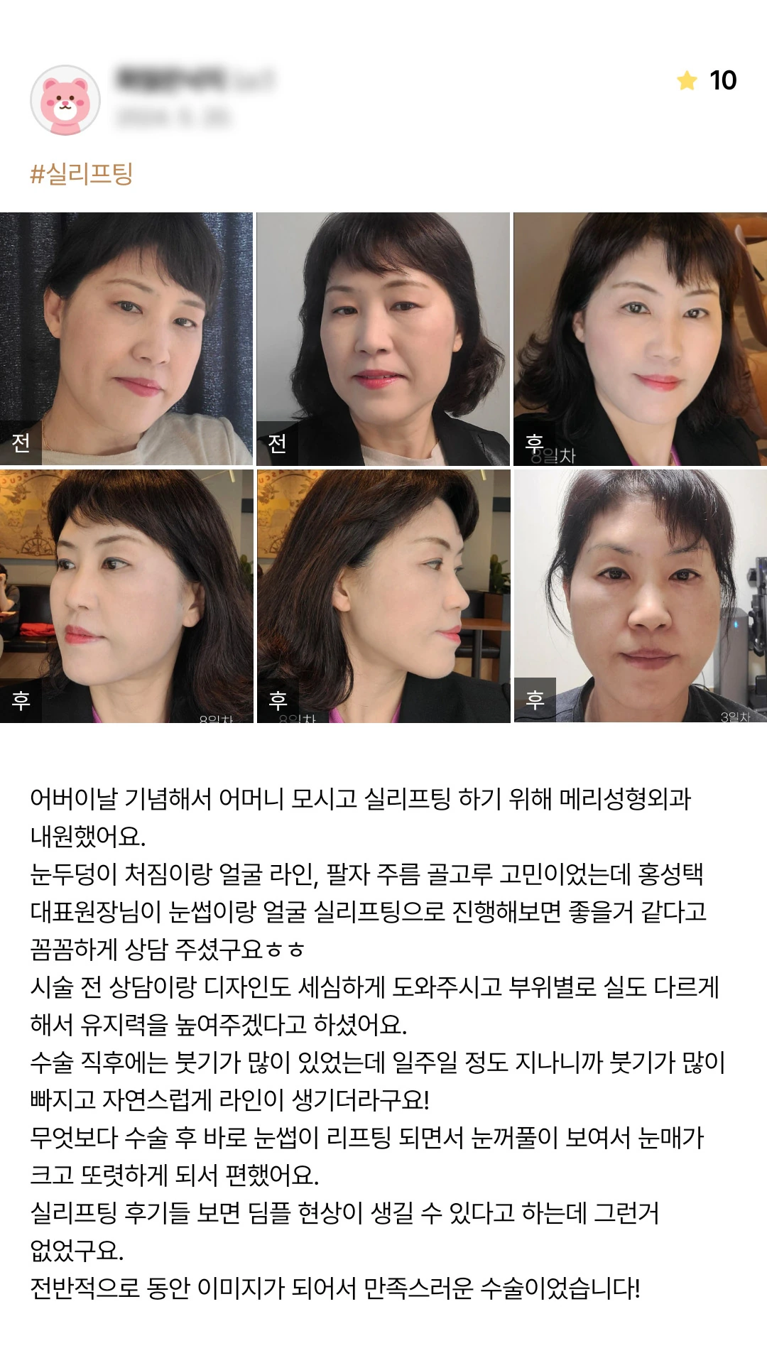 Thread lifting patient photo review — 248 at Merry Plastic Surgery Clinic. Thread lifting at Merry Plastic Surgery: before-and-after photographs shown in the supplied patient review.