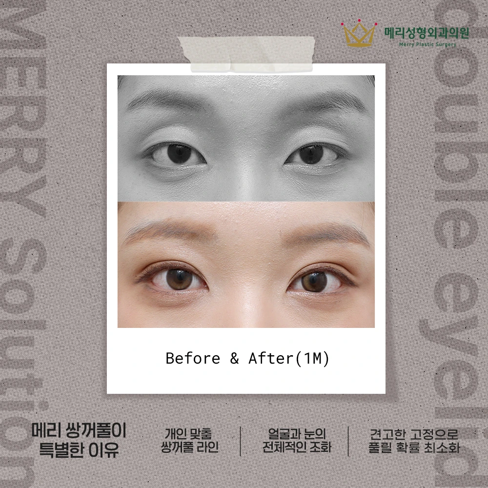 Double-eyelid surgery before and after — 252 at Merry Plastic Surgery Clinic. Double-eyelid surgery at Merry Plastic Surgery: before-and-after photographs shown in the supplied clinic comparison. The source labels the follow-up as 1 month.