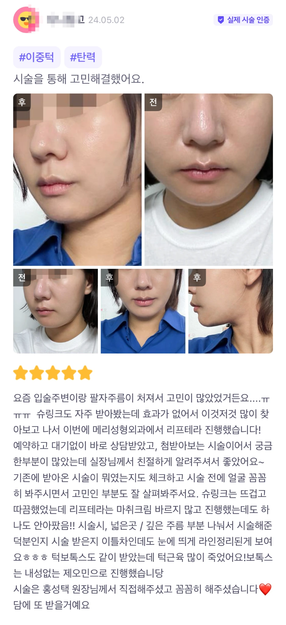 Liftera ultrasound lifting and masseter botulinum toxin patient photo review — 261 at Merry Plastic Surgery Clinic. Liftera ultrasound lifting and masseter botulinum toxin at Merry Plastic Surgery: before-and-after photographs shown in the supplied patient review.