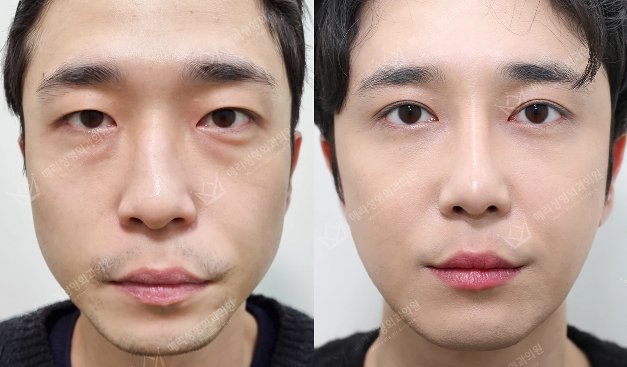 Eyelid and functional nose surgery: four comparison views at Merry Plastic Surgery Clinic. Merry Plastic Surgery Clinic, Seoul: Front-view comparison following combined eyelid and nose surgery.