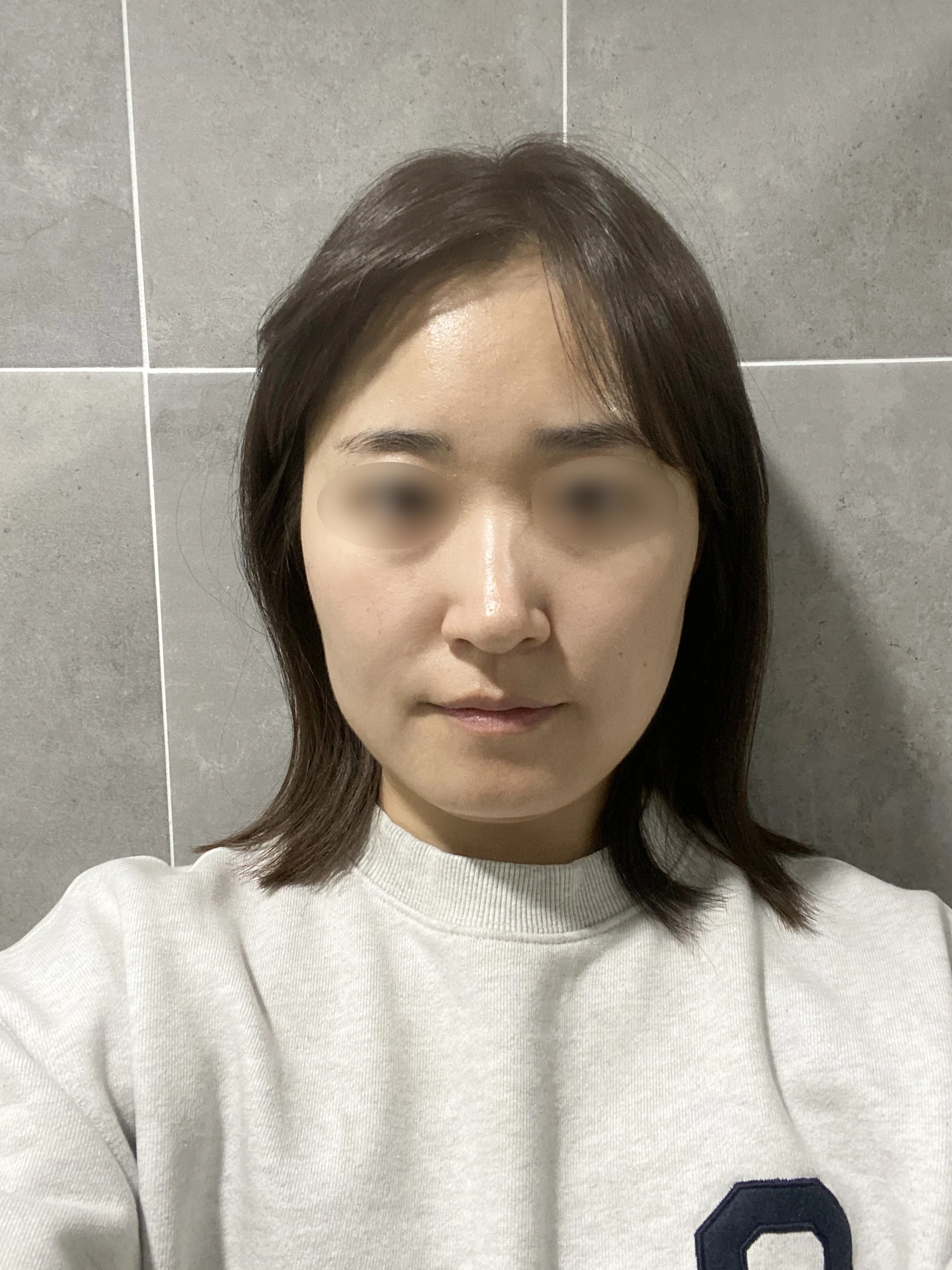 Double-chin liposuction and muscle tying: two-month case 1 at Merry Plastic Surgery Clinic. Merry Plastic Surgery Clinic, Seoul: Double-chin liposuction and muscle tying, before surgery, view 1.