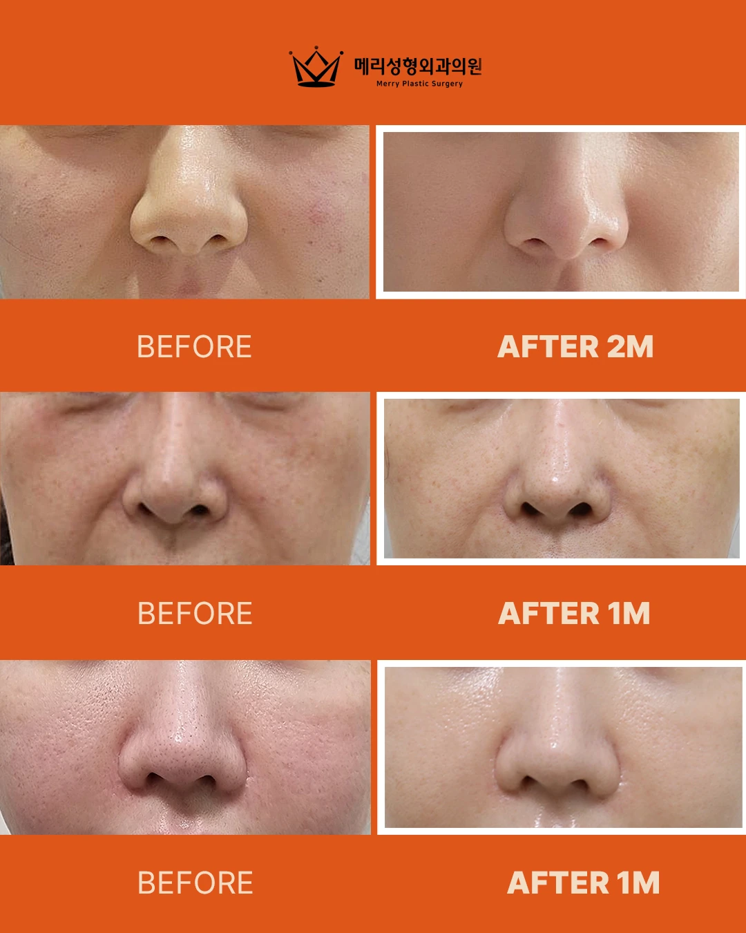 Re2O skin treatment before and after — 291 at Merry Plastic Surgery Clinic. Three Re2O skin-treatment comparisons focused on the midface and nose-side cheek area. The source labels two follow-ups at 2 months and one at 1 month.
