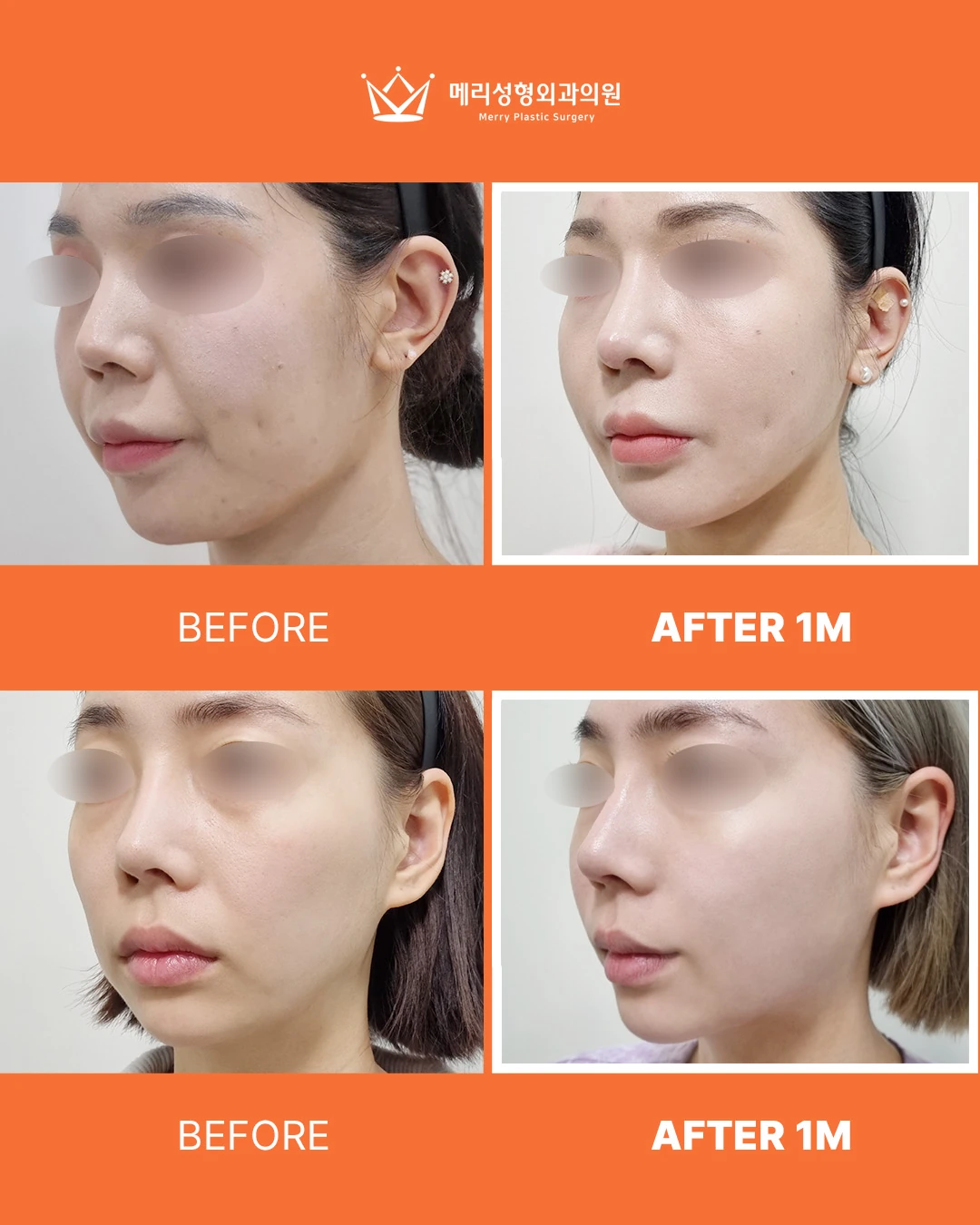 Thread lifting before and after — 292 at Merry Plastic Surgery Clinic. Thread lifting at Merry Plastic Surgery: before-and-after photographs shown in the supplied clinic comparison. The source labels the follow-up as 1 month.