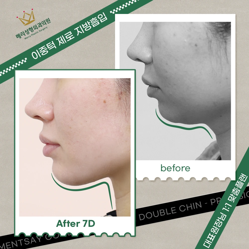 Double-chin liposuction with muscle tightening and fixation before and after — 293 at Merry Plastic Surgery Clinic. Double-chin liposuction with muscle tightening and fixation at Merry Plastic Surgery: before-and-after photographs shown in the supplied clinic comparison. The source labels the follow-up as 7 days.