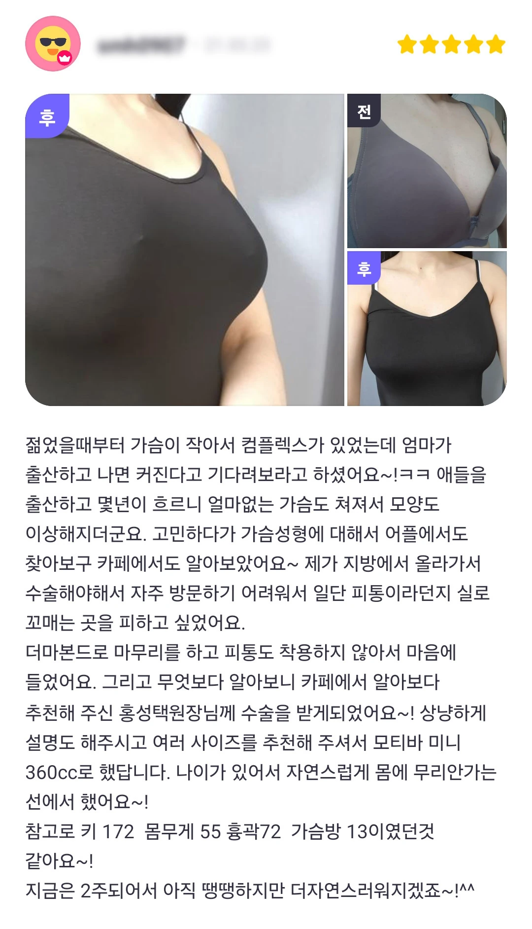 Breast augmentation patient photo review — 299 at Merry Plastic Surgery Clinic. Breast augmentation at Merry Plastic Surgery: before-and-after photographs shown in the supplied patient review. The source labels the follow-up as 2 weeks.