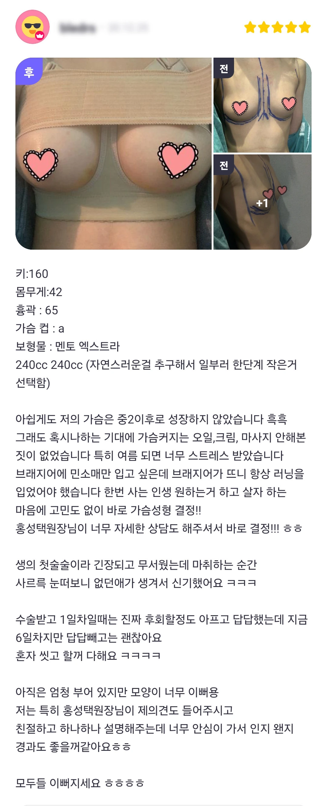 Breast augmentation patient photo review — 300 at Merry Plastic Surgery Clinic. Breast augmentation at Merry Plastic Surgery: before-and-after photographs shown in the supplied patient review.