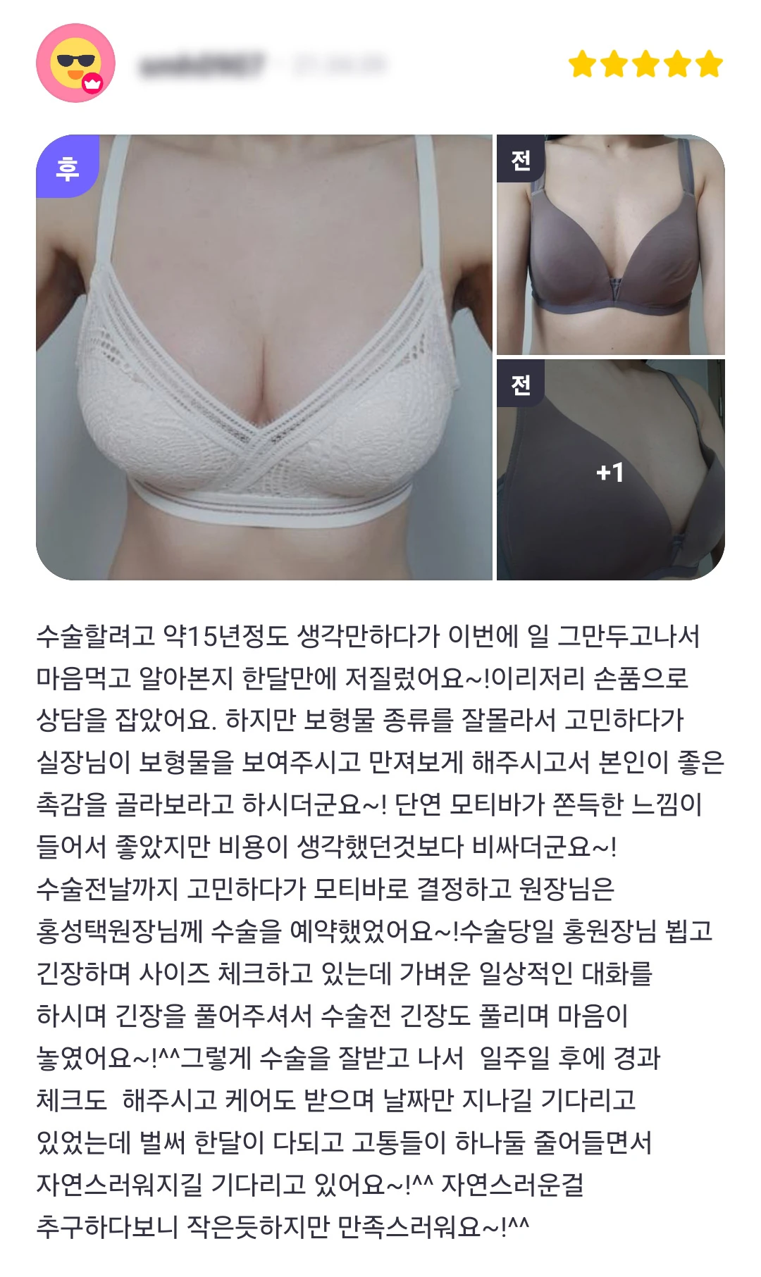 Breast augmentation patient photo review — 303 at Merry Plastic Surgery Clinic. Breast augmentation at Merry Plastic Surgery: before-and-after photographs shown in the supplied patient review. The source labels the follow-up as 1 week.
