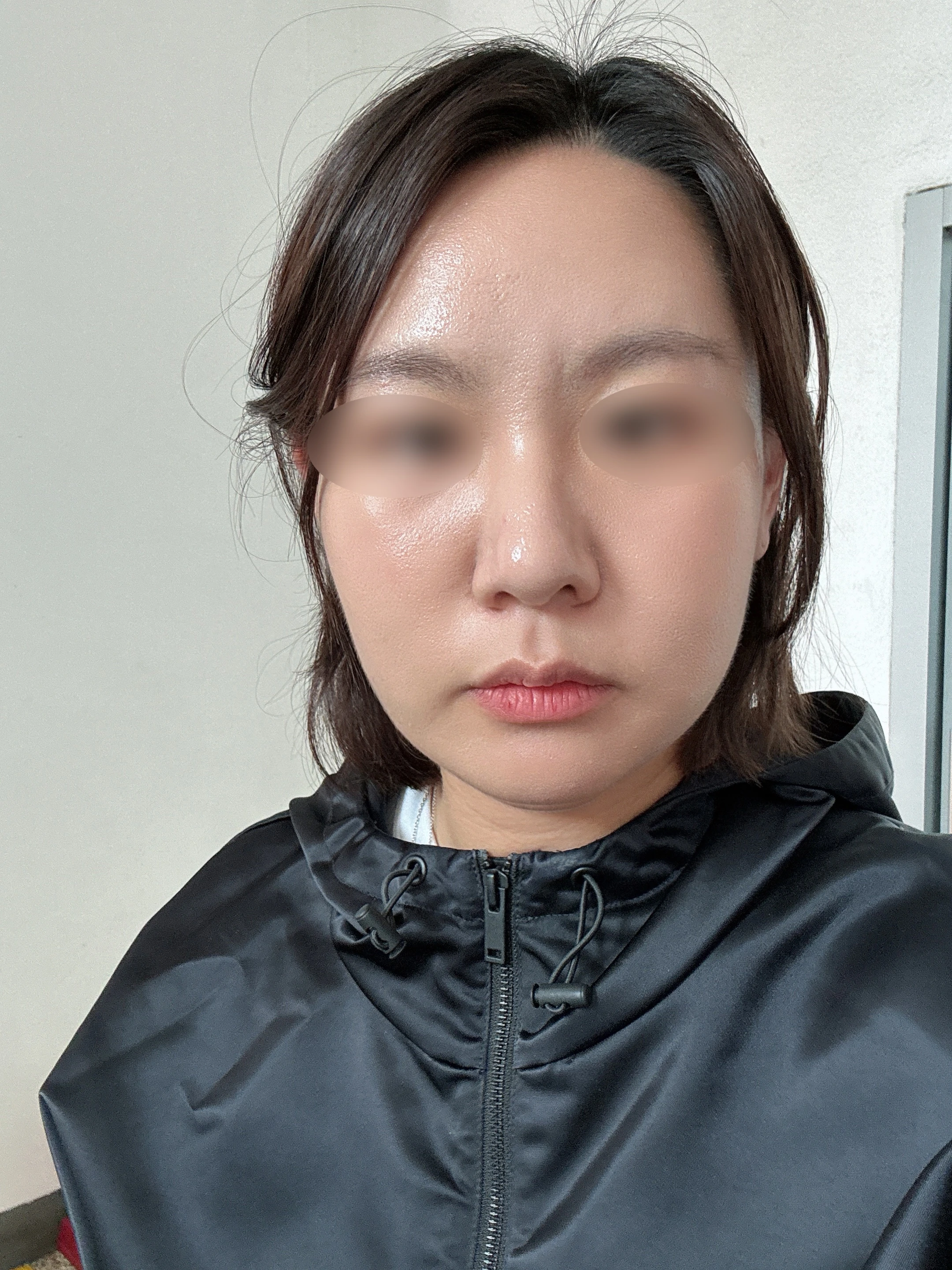 Double-chin liposuction and muscle tying: two-month case 2 at Merry Plastic Surgery Clinic. Merry Plastic Surgery Clinic, Seoul: Double-chin liposuction and muscle tying, before surgery, view 1.