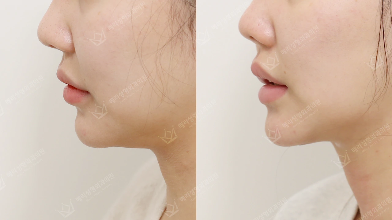 Double-chin contouring: profile 1 at Merry Plastic Surgery Clinic. Merry Plastic Surgery Clinic, Seoul: Double-chin contouring, before and after comparison, view 1.