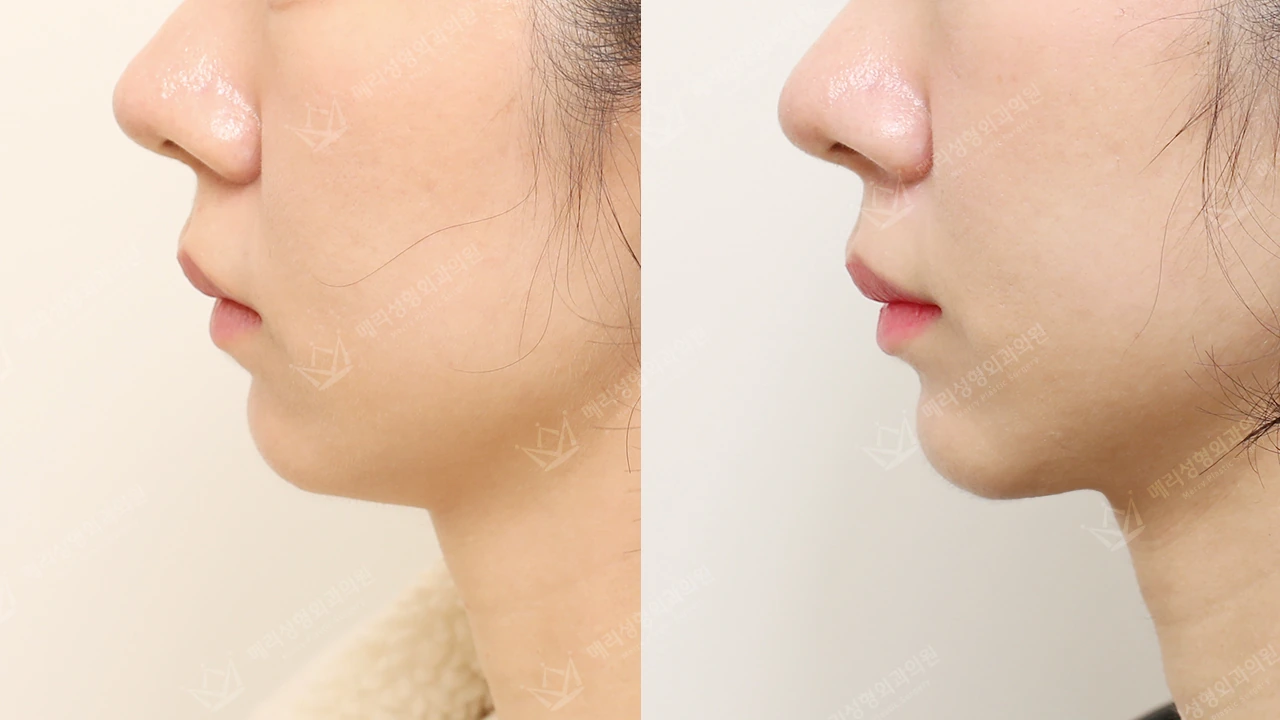 Double-chin contouring: clinic comparison panels at Merry Plastic Surgery Clinic. Merry Plastic Surgery Clinic, Seoul: Double-chin contouring, before and after comparison, view 1.