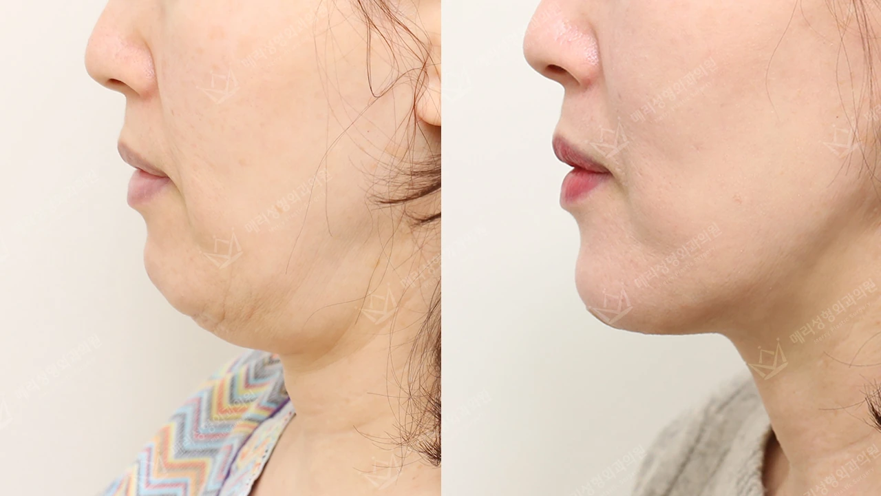 Double-chin contouring: profile 3 at Merry Plastic Surgery Clinic. Merry Plastic Surgery Clinic, Seoul: Double-chin contouring, before and after comparison, view 1.