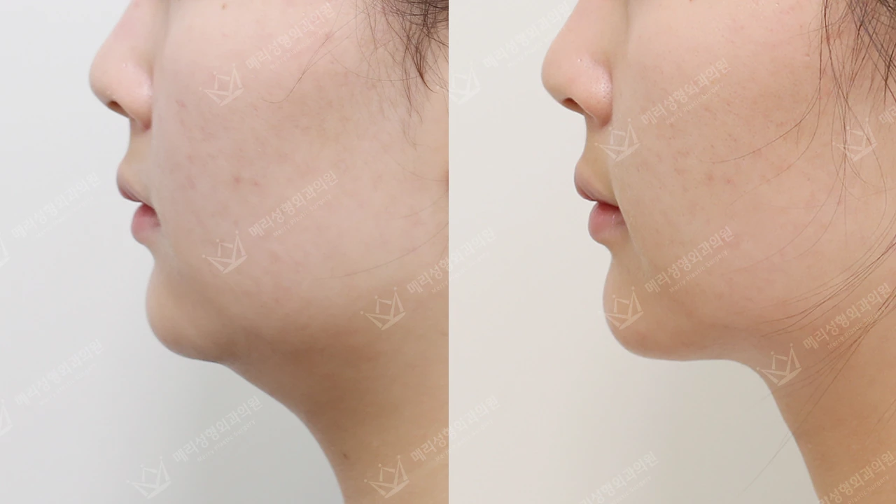 Double-chin contouring: profile 4 at Merry Plastic Surgery Clinic. Merry Plastic Surgery Clinic, Seoul: Double-chin contouring, before and after comparison, view 1.