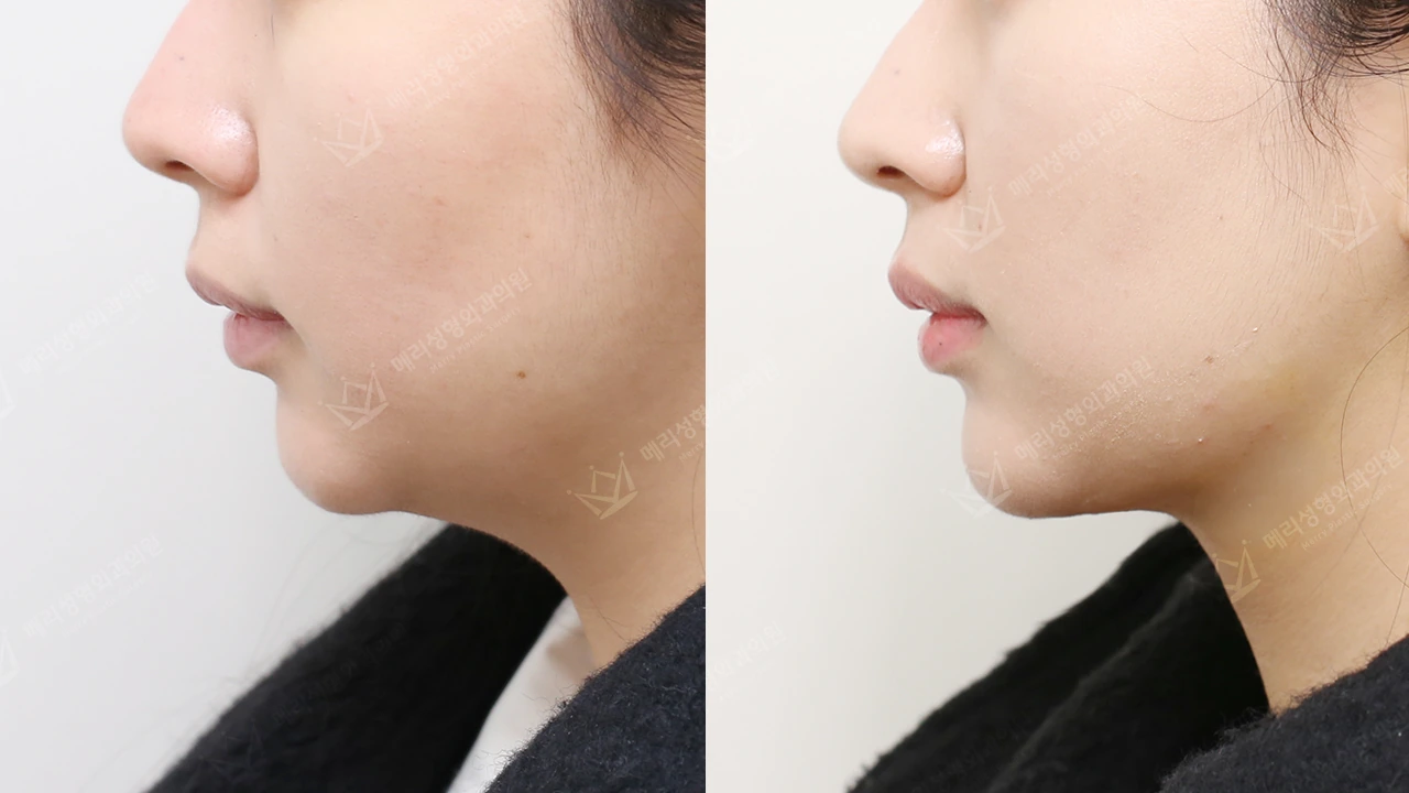 Double-chin contouring: profile 5 at Merry Plastic Surgery Clinic. Merry Plastic Surgery Clinic, Seoul: Double-chin contouring, before and after comparison, view 1.