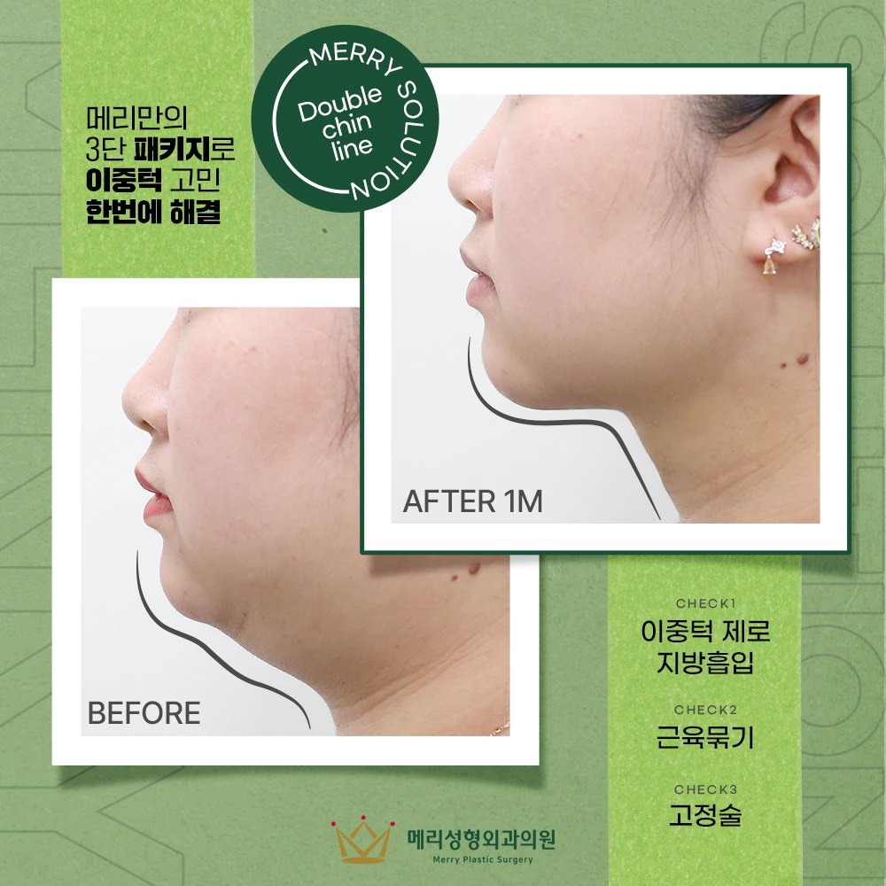 Double-chin liposuction with muscle tightening and fixation before and after — 329 at Merry Plastic Surgery Clinic. Double-chin liposuction with muscle tightening and fixation at Merry Plastic Surgery: before-and-after photographs shown in the supplied clinic comparison. The source labels the follow-up as 1 month.